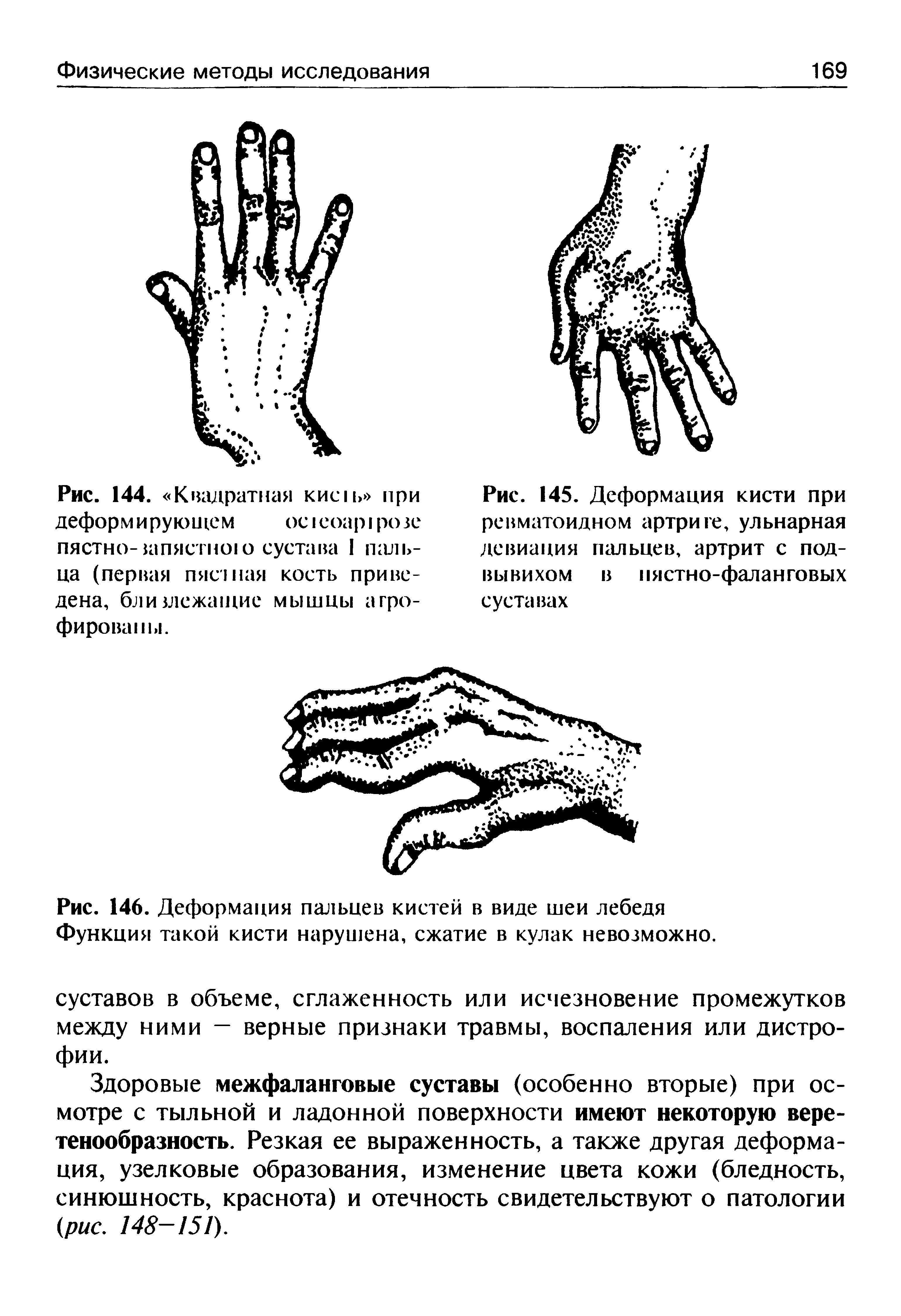 Рис. 145. Деформация кисти при ревматоидном артрите, ульнарная девиация пальцев, артрит с подвывихом в пястно-фаланговых суставах...