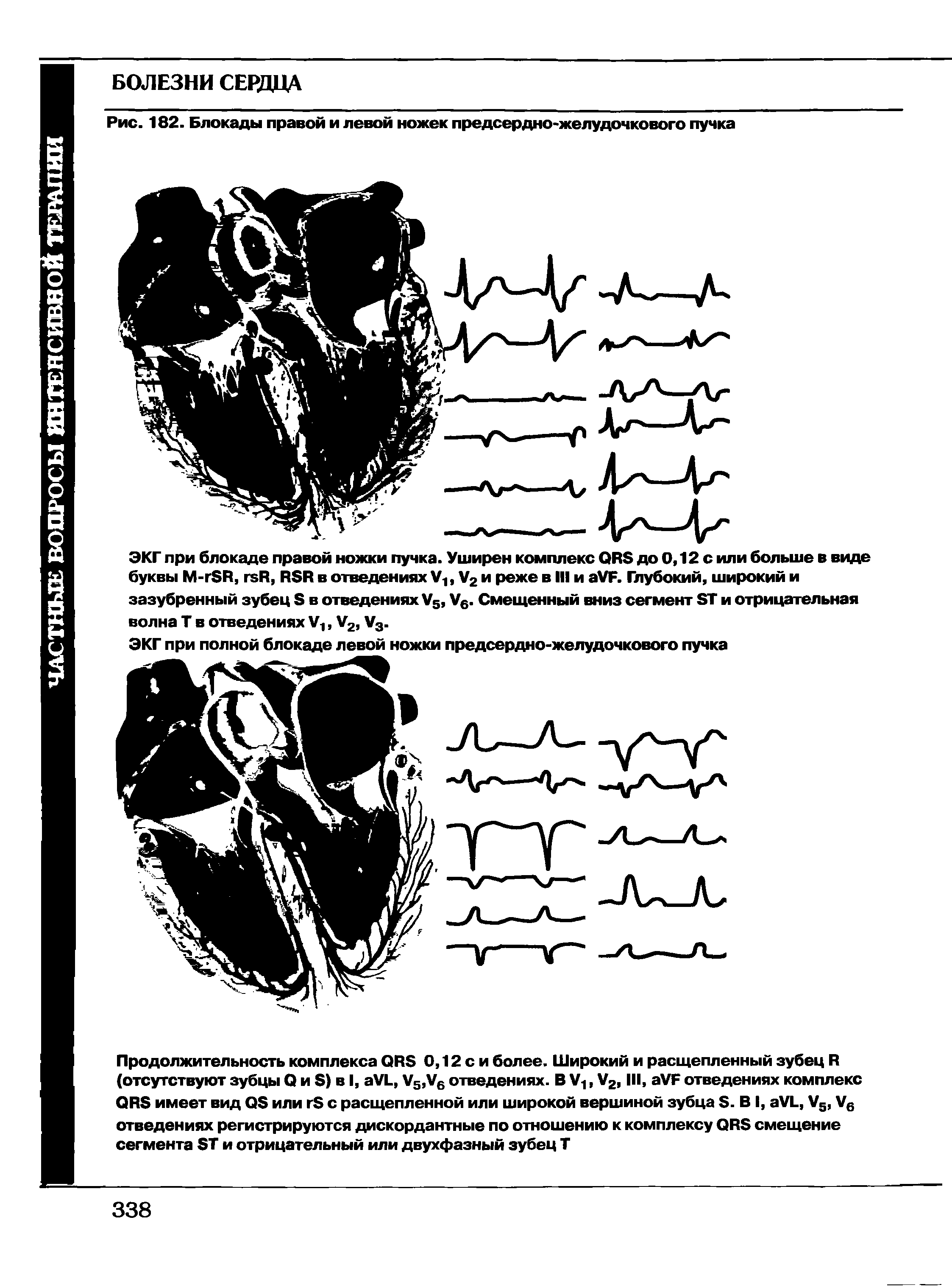 Рис. 182. Блокады правой и левой ножек предсердно-желудочкового пучка...
