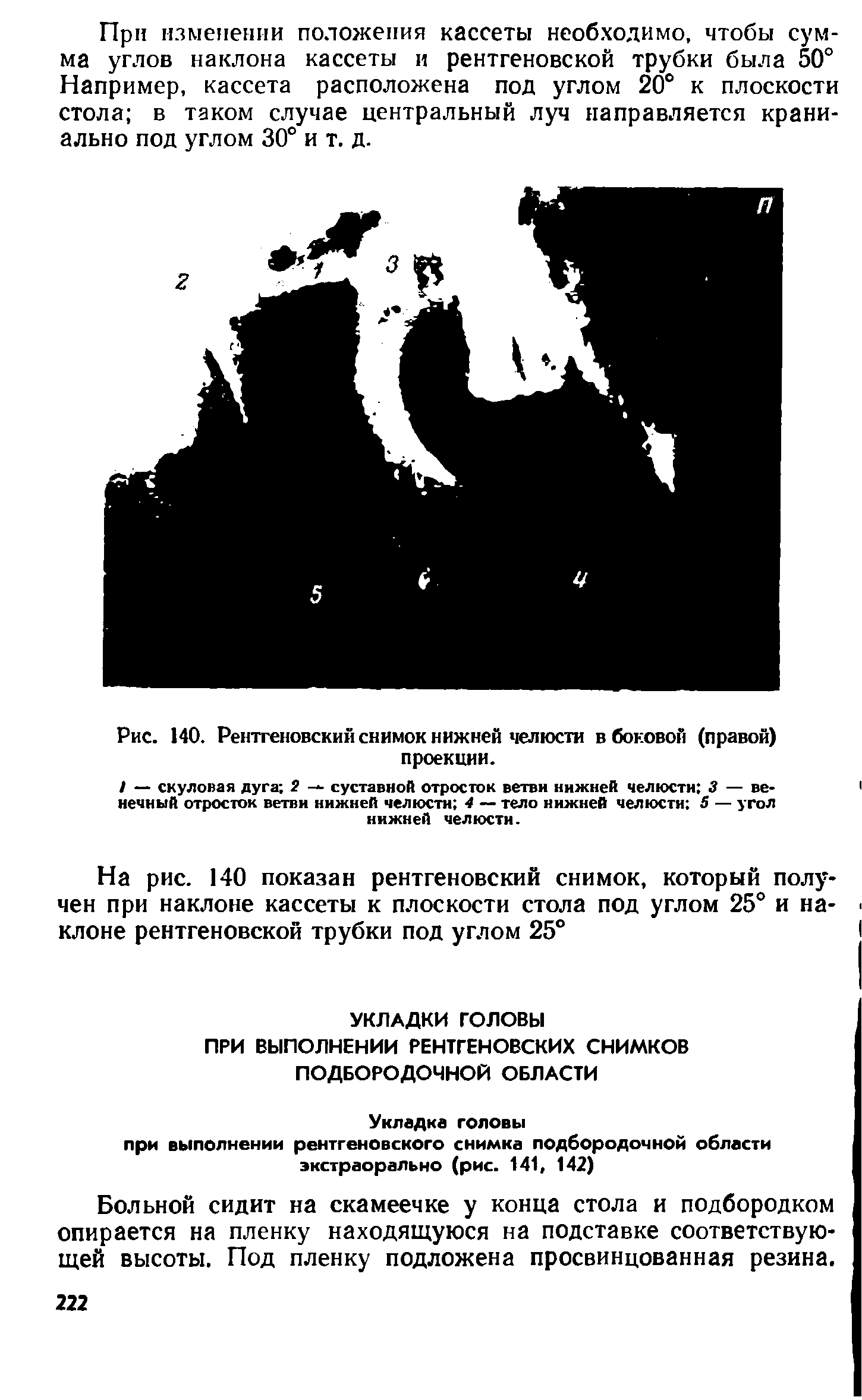 Рис. 140. Рентгеновский снимок нижней челюсти в боковой (правой) проекции.