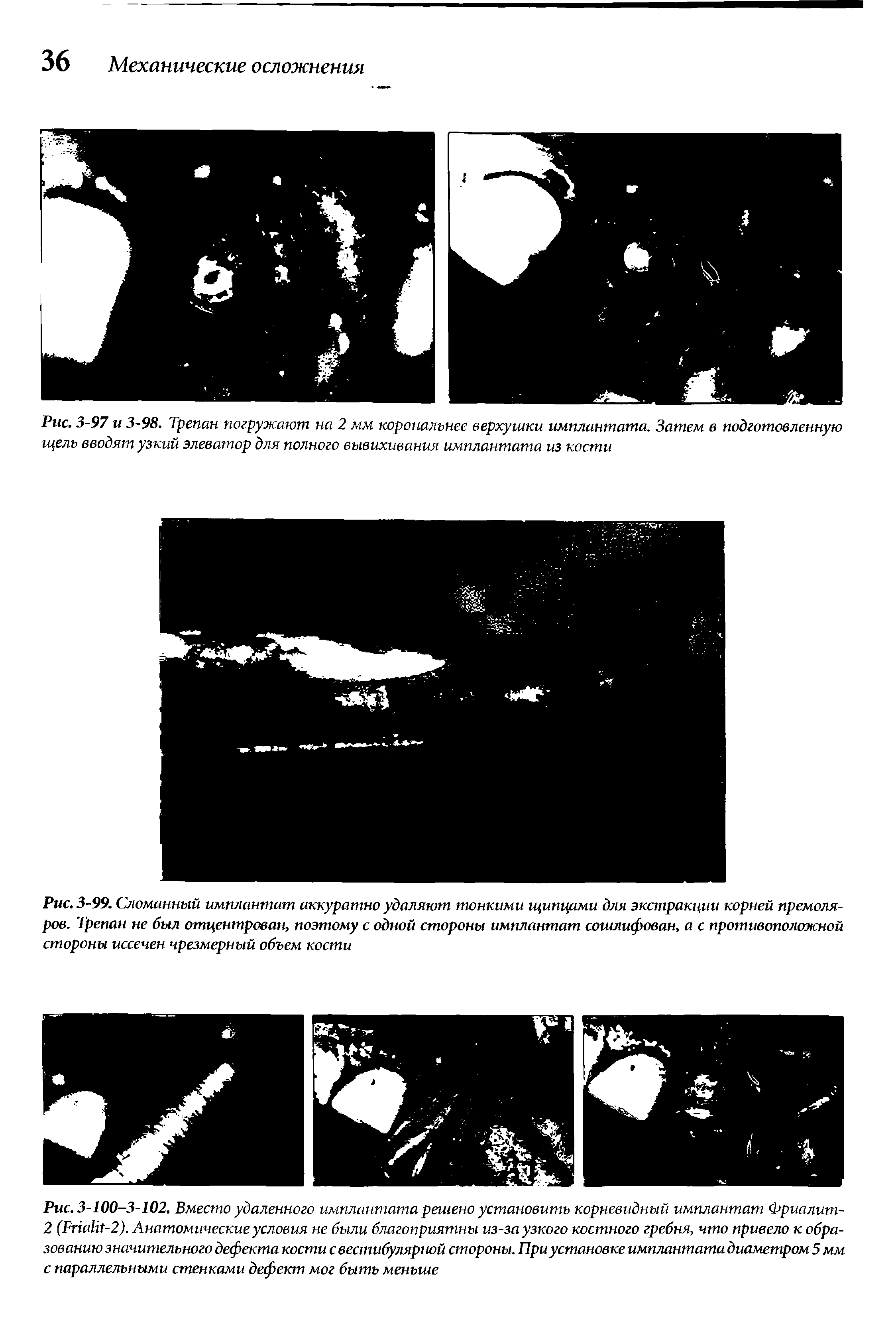 Рис. 3-99. Сломанный имплантат аккуратно удаляют тонкими щипцами для экстракции корней премоляров. Трепан не был отцентрован, поэтому с одной стороны имплантат сошлифован, а с противоположной стороны иссечен чрезмерный объем кости...