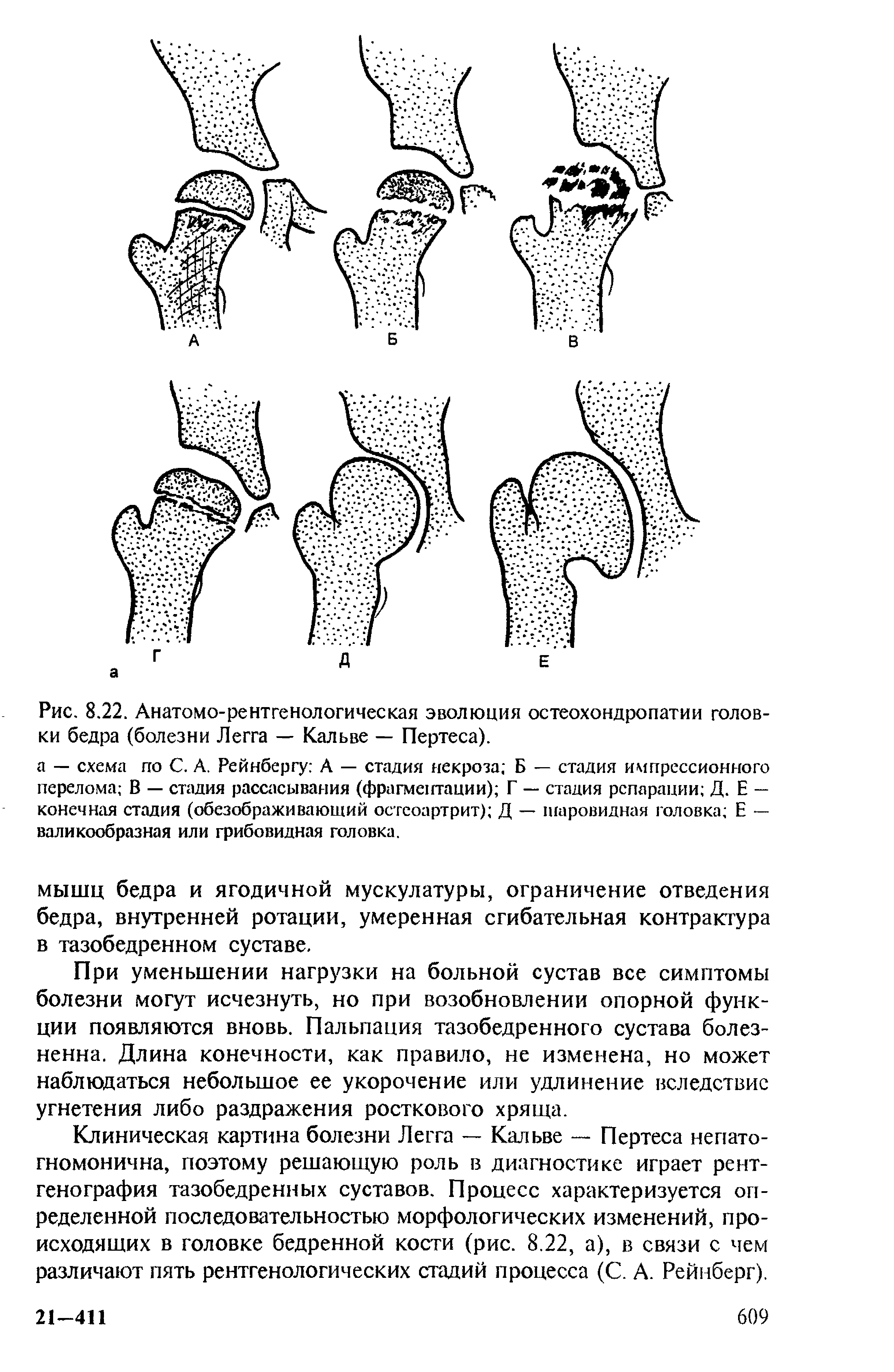 Рис. 8.22. Анатомо-рентгенологическая эволюция остеохондропатии головки бедра (болезни Л — Кальве — Пертеса).