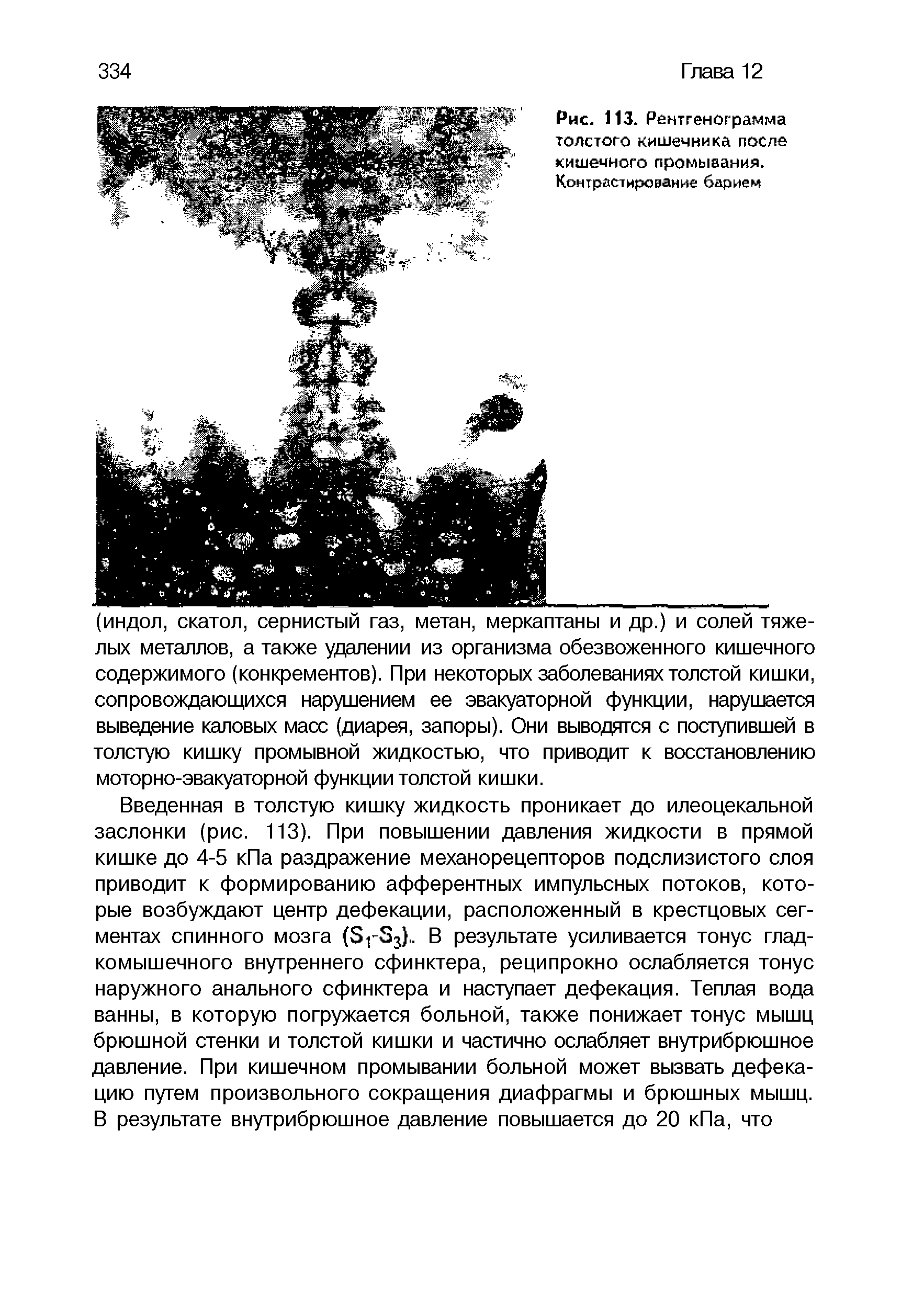 Рис. 113. Рентгенограмма толстого кишечника после кишечного промывания. Контрастирование барием...