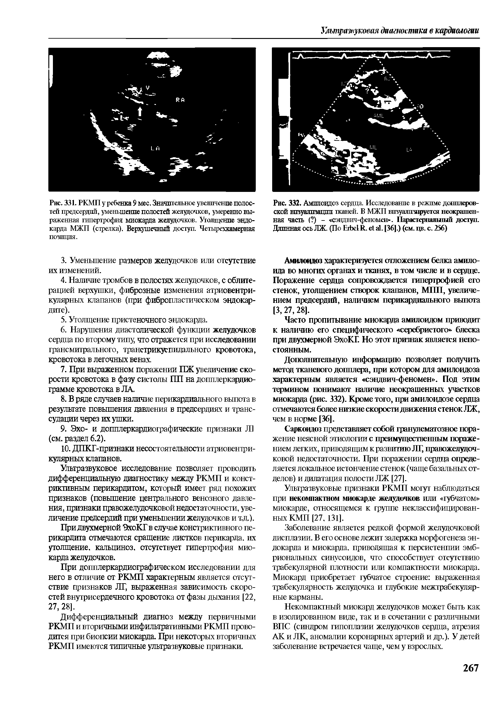 Рис. 332. Ампловдоз сердца. Исследование в режиме допплеровской визуализации тканей. В МЖП визуализируется неокрашенная часть ( ) - сэндвич-феномен . Пярястерттяльньпт доступ. Длинная ось ЛЖ. (По ЕтЬе1К. е а1. [36].) (см. цв. с. 256)...