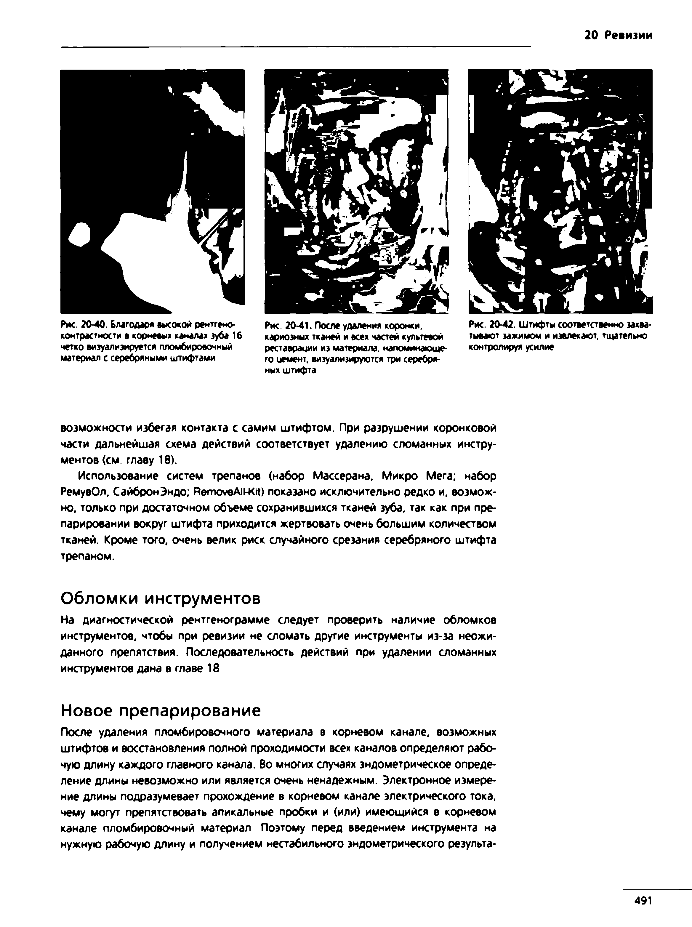 Рис. 20-41. После удаления коронки, кариозных тканей и всех частей культовой реставрации из материала, напоминающего цемент, визуализируются три серебряных штифта...