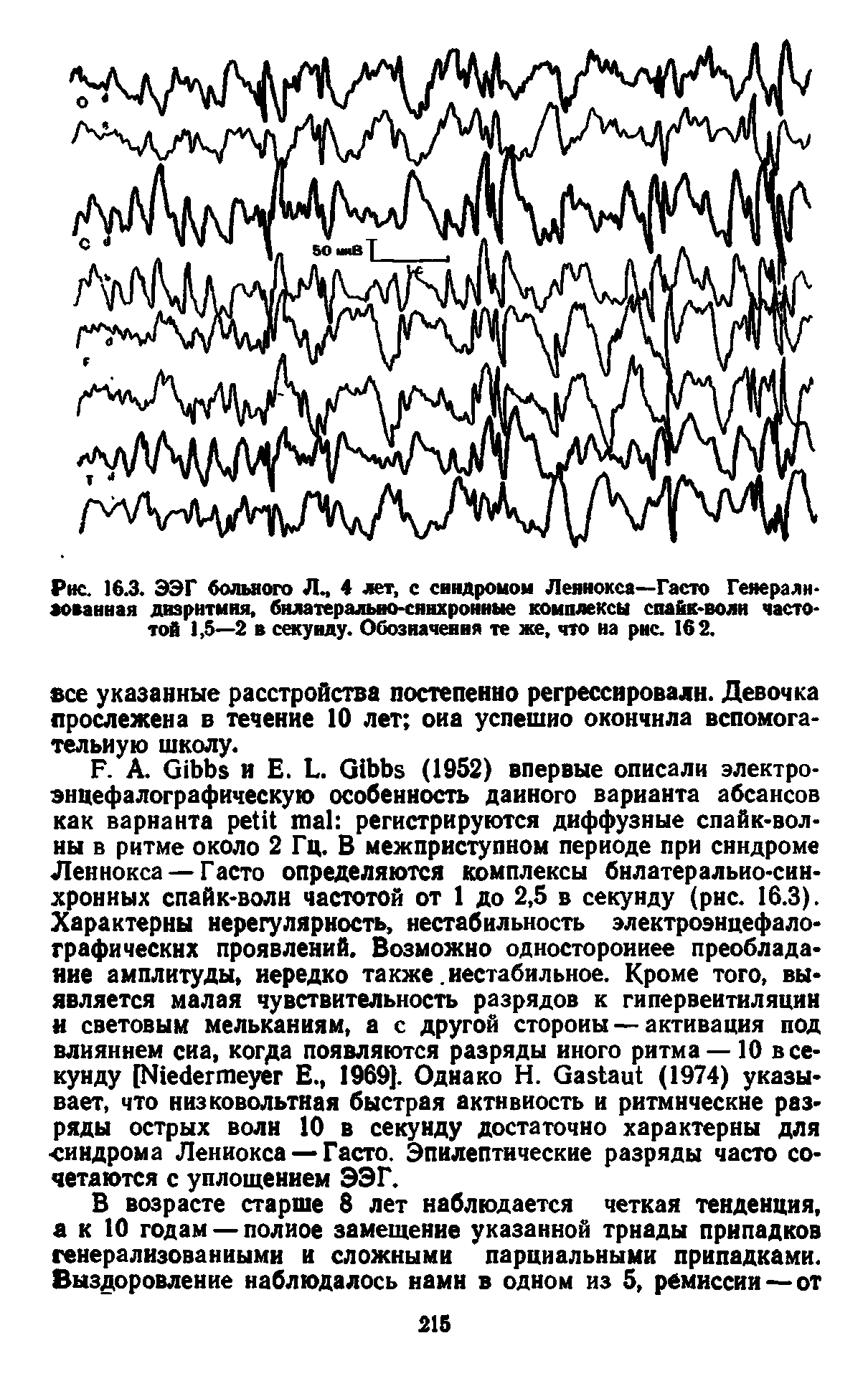 Рис. 16.3. ЭЭГ больного Л., 4 лет, с синдромом Леннокса—Гасто Генерализованная дизритмия, билатерально-синхронные комплексы спайк-воли частотой 1,5—2 в секунду. Обозначения те же, что на рис. 162.