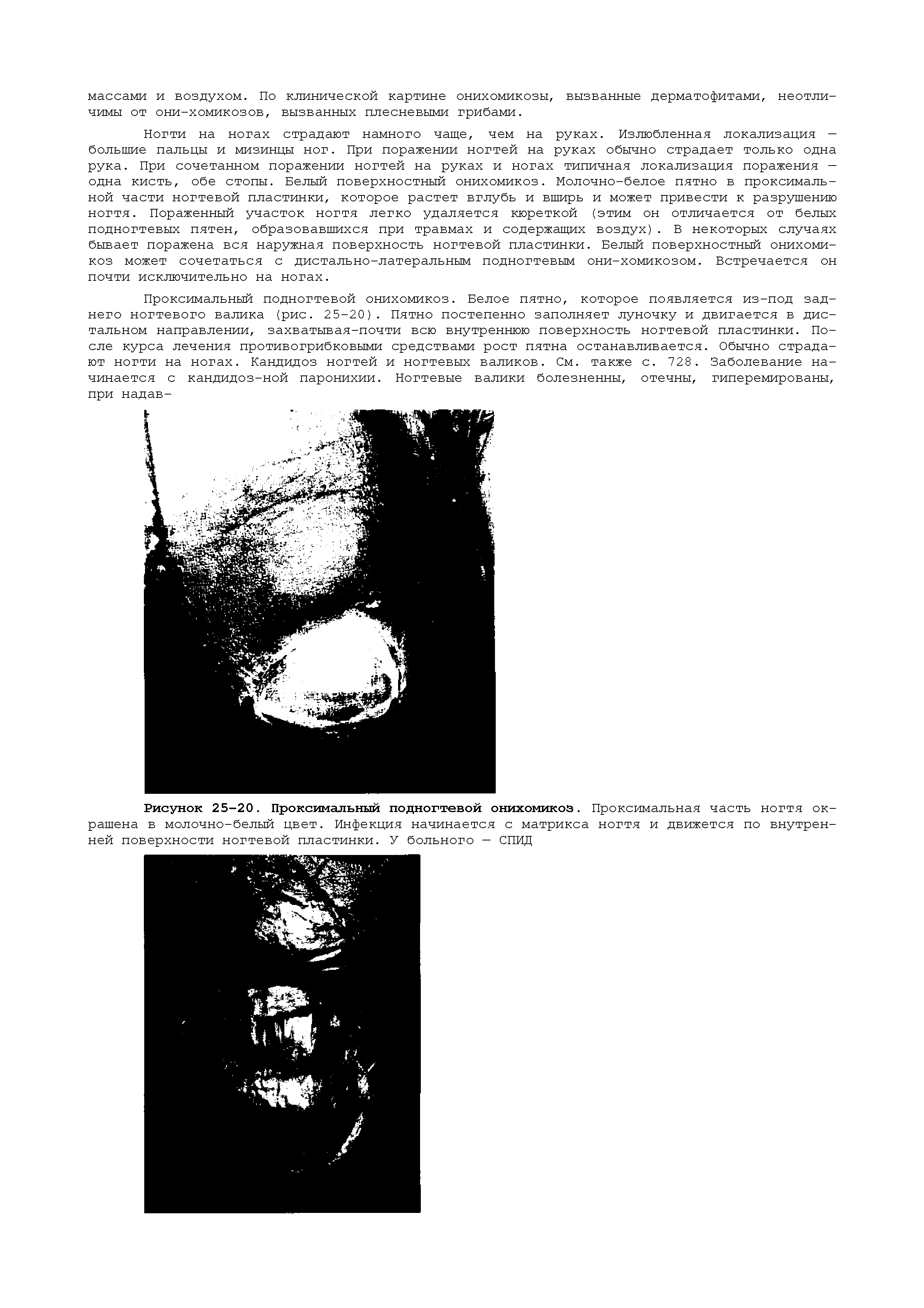 Рисунок 25-20. Проксимальный подногтевой онихомикоз. Проксимальная часть ногтя окрашена в молочно-белый цвет. Инфекция начинается с матрикса ногтя и движется по внутренней поверхности ногтевой пластинки. У больного — СПИД...