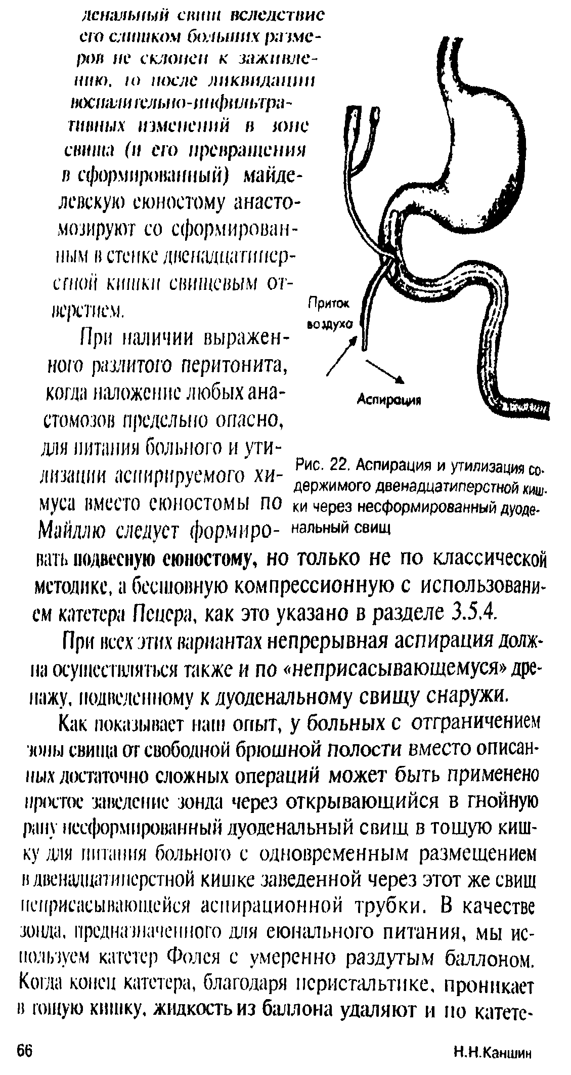 Рис. 22. Аспирация и утилизация содержимого двенадцатиперстной киш-ки через несформированный дуоденальный свищ...