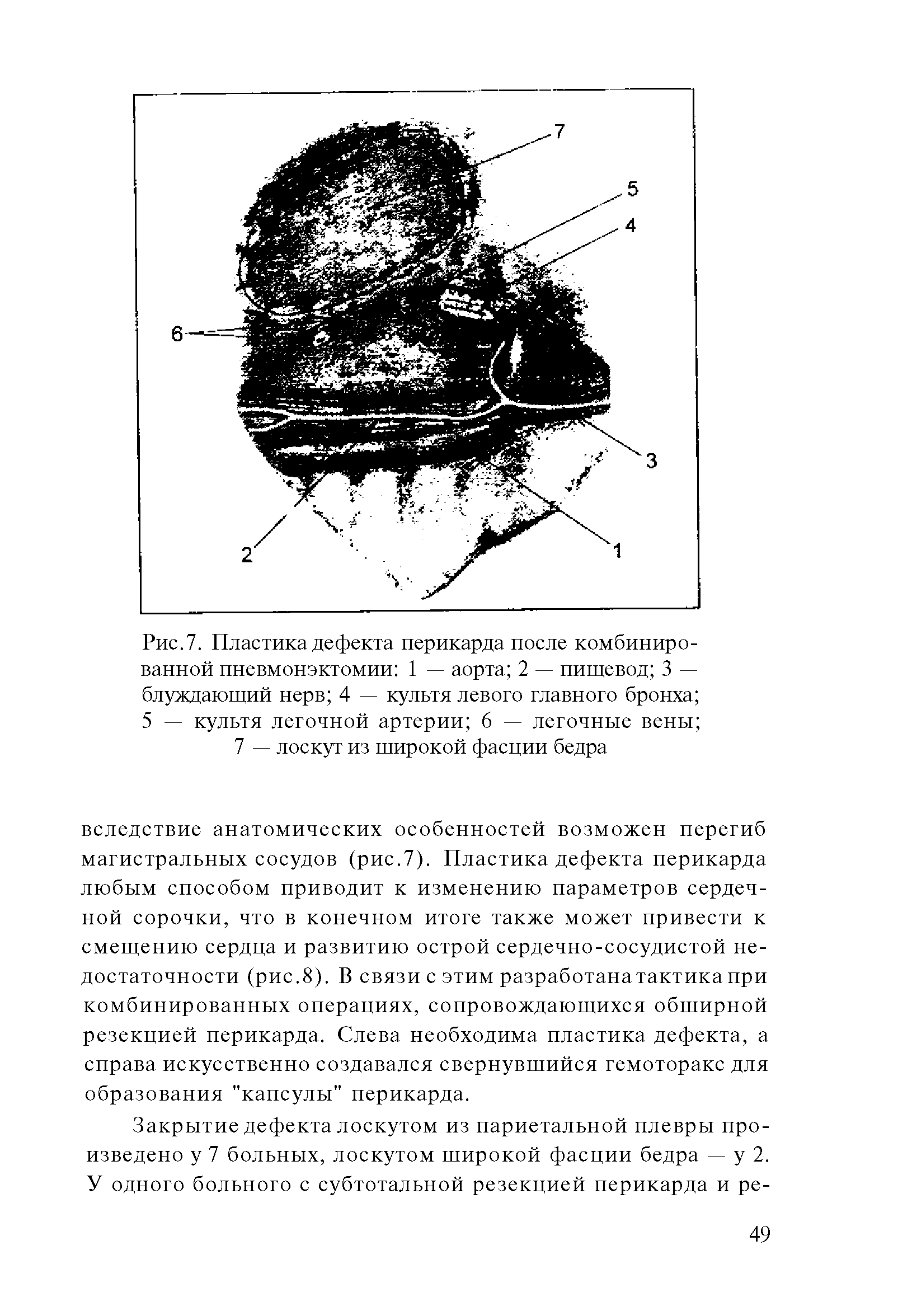 Рис.7. Пластика дефекта перикарда после комбинированной пневмонэктомии 1 — аорта 2 — пищевод 3 — блуждающий нерв 4 — культя левого главного бронха 5 — культя легочной артерии 6 — легочные вены ...