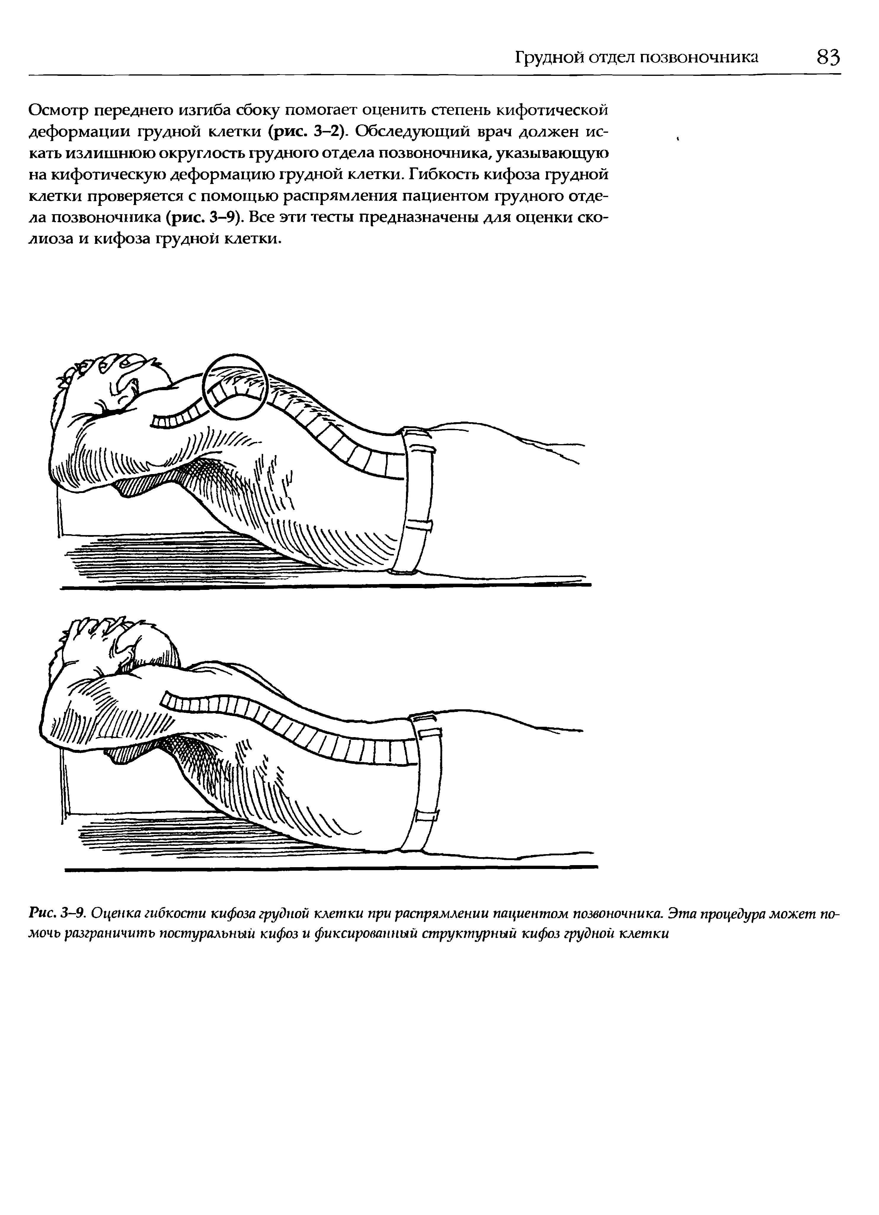 Рис. 3-9. Оценка гибкости кифоза грудной клетки при распрямлении пациентом позвоночника. Эта процедура может помочь разграничить постуральный кифоз и фиксированный структурный кифоз грудной клетки...