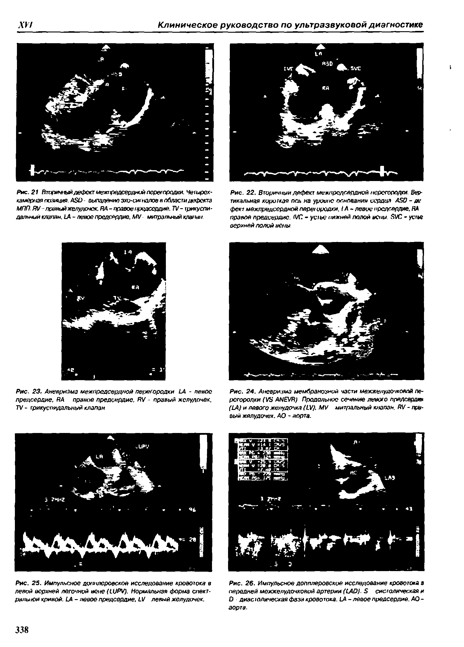 Рис. 24. Аневризма мембранозной части межжелудочковой перегородки (УЭ АНЕУН) Продольное сечение левого предсердия (1А) и левого желудочка (СУ). МУ митральный клапан. РУ - правый желудочек. АО - аорта.