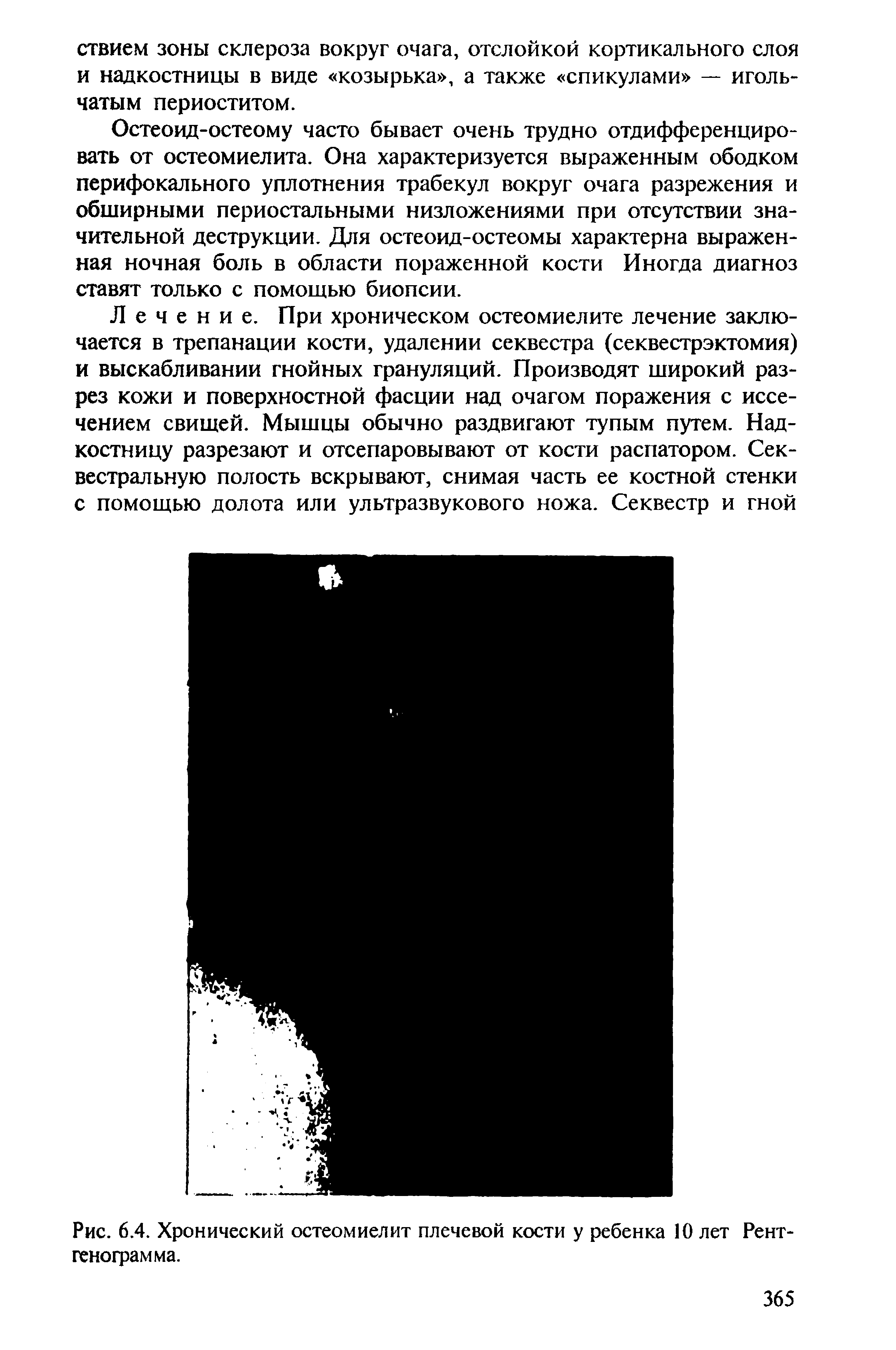 Рис. 6.4. Хронический остеомиелит плечевой кости у ребенка 10 лет Рентгенограмма.