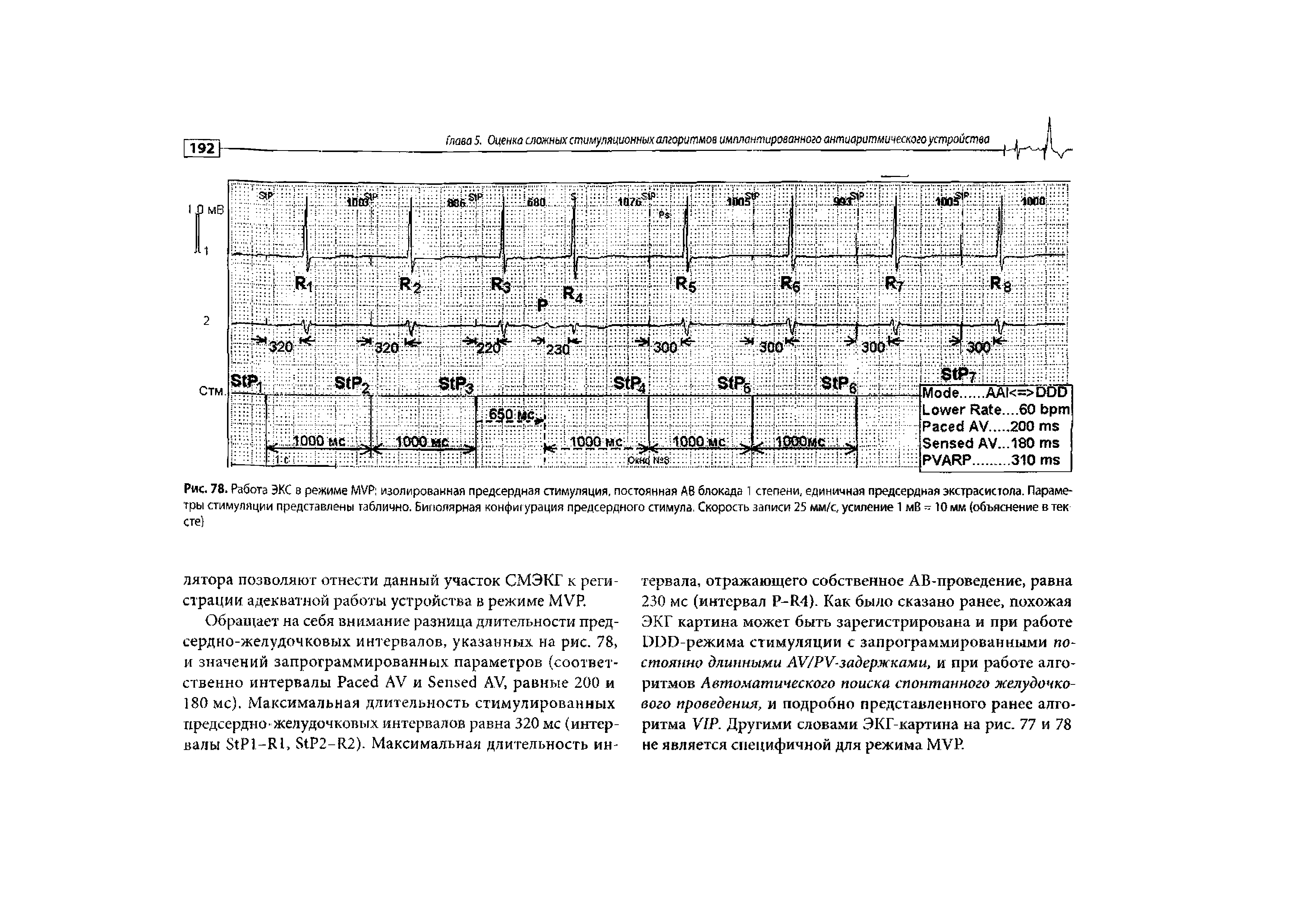 Рис. 78. Работа ЭКС в режиме MVP изолированная предсердная стимуляция, постоянная АВ блокада 1 степени, единичная предсердная экстрасистола. Параметры стимуляции представлены таблично. Биполярная конфигурация предсердного стимула. Скорость записи 25 мм/с, усиление 1 мВ - 10 мм (объяснение в тек сте)...