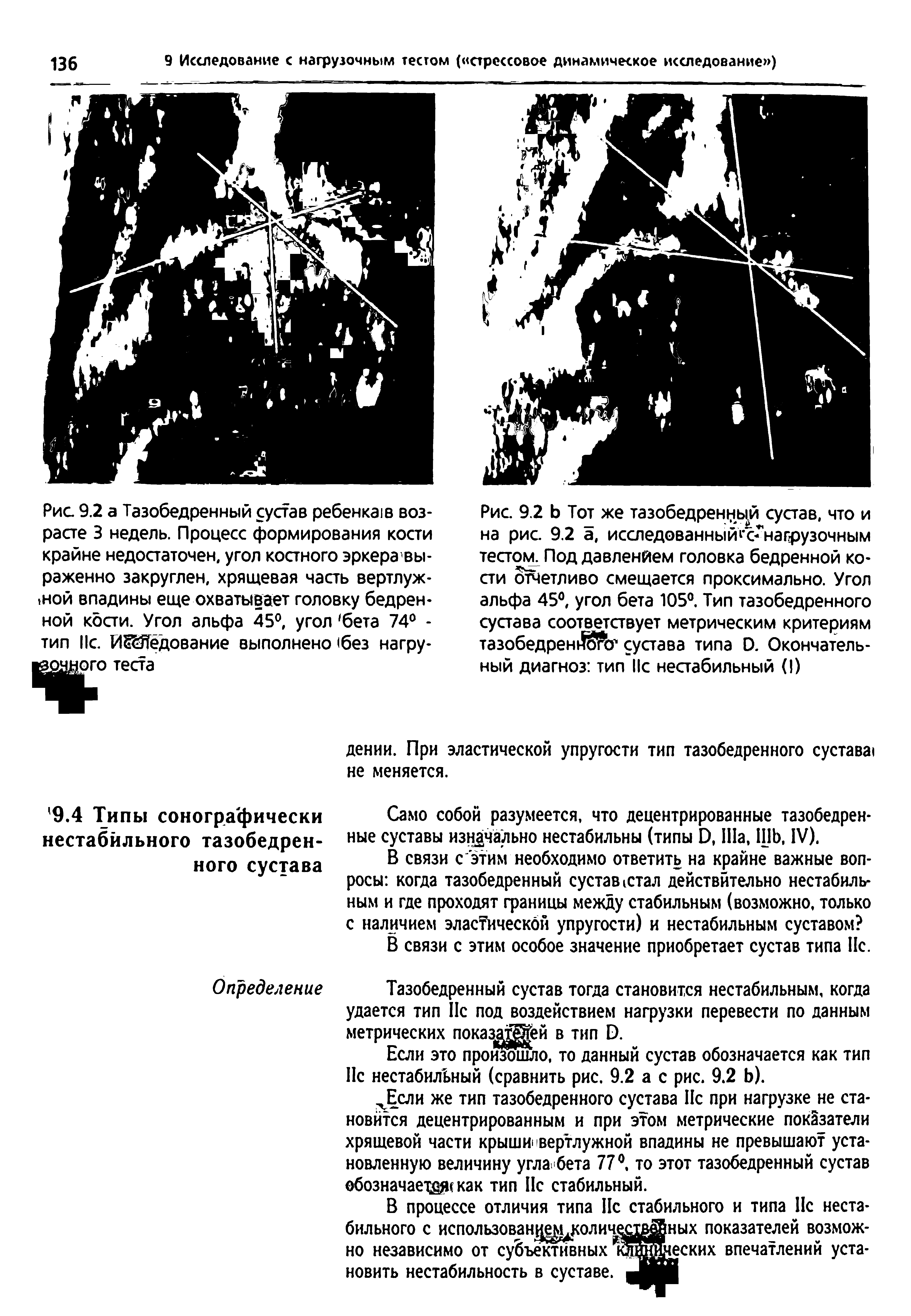 Рис. 9.2 Ь Тот же тазобедренной сустав, что и на рис. 9.2 а, исследованный онагрузочным тестом Под давлением головка бедренной кости отчетливо смещается проксимально. Угол альфа 45°, угол бета 105°. Тип тазобедренного сустава соответствует метрическим критериям тазобедренного сустава типа D. Окончательный диагноз тип Пс нестабильный (I)...