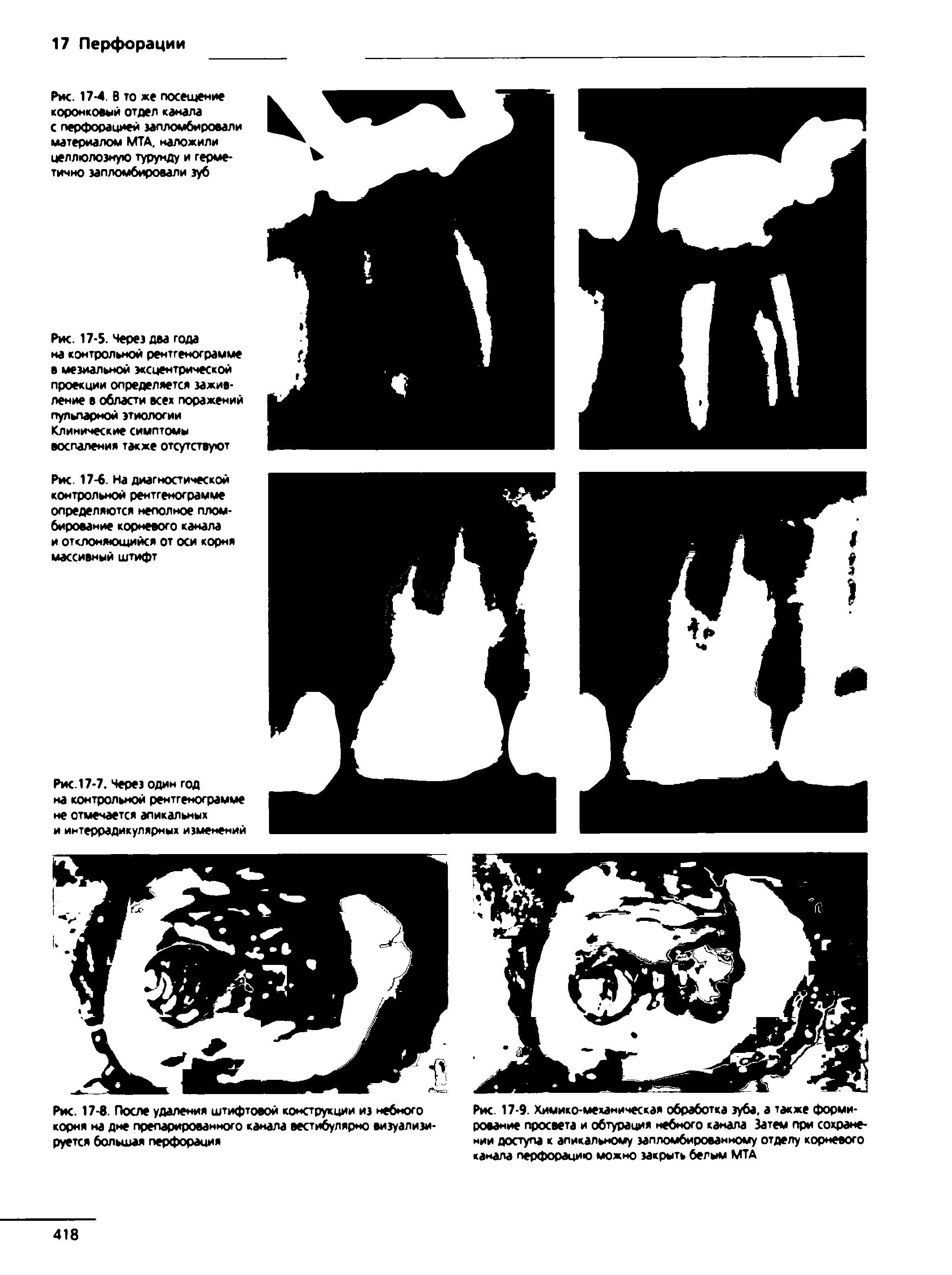 Рис. 17-9. Химико-механическая обработка зуба, а также формирование просвета и обтурация небного канала Затем при сохранении доступа к апикальному запломбированному отделу корневого канала перфорацию можно закрыть белым МТА...