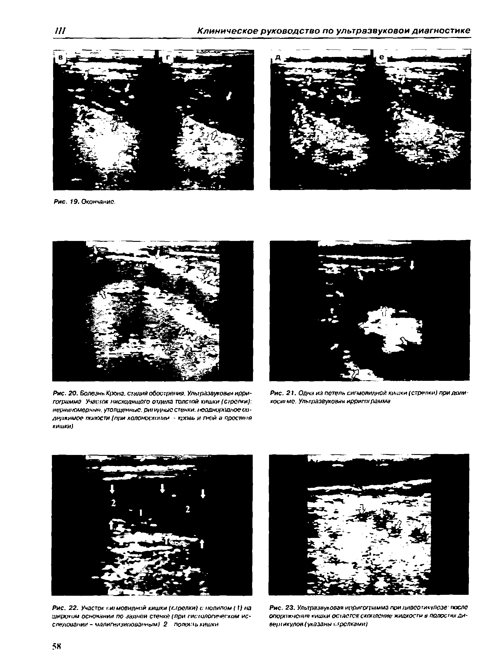 Рис. 22. Учдстрл- си/мовил ой кишки (стрелки) с нолипам I1) а широким основании по задней стенке (при / ис.го/югмчегком ис-слез1Овании - малигнизированным) 2 лолея. 1ь кишки...