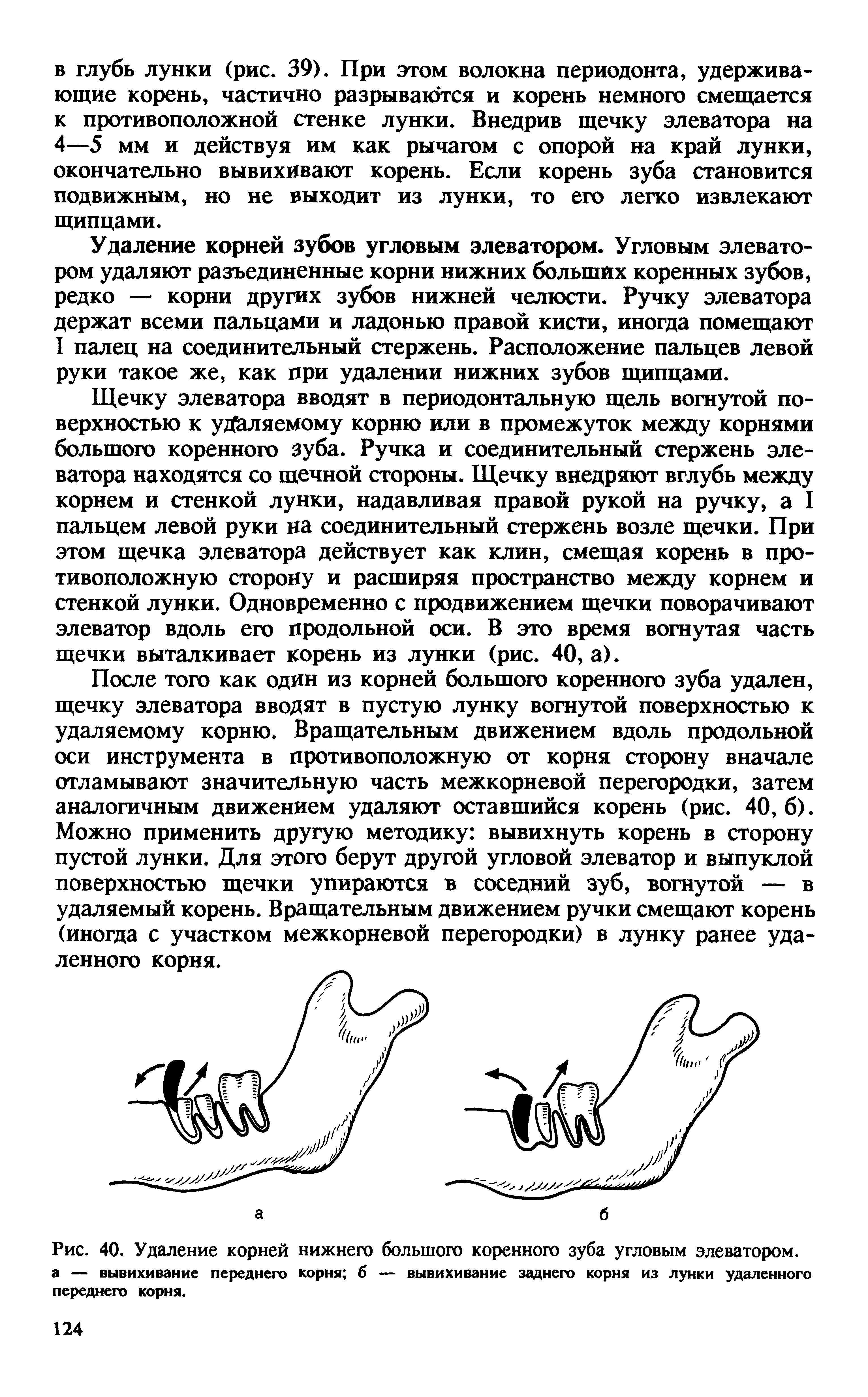 Рис. 40. Удаление корней нижнего большого коренного зуба угловым элеватором, а — вывихивание переднего корня б — вывихивание заднего корня из лунки удаленного переднего корня.