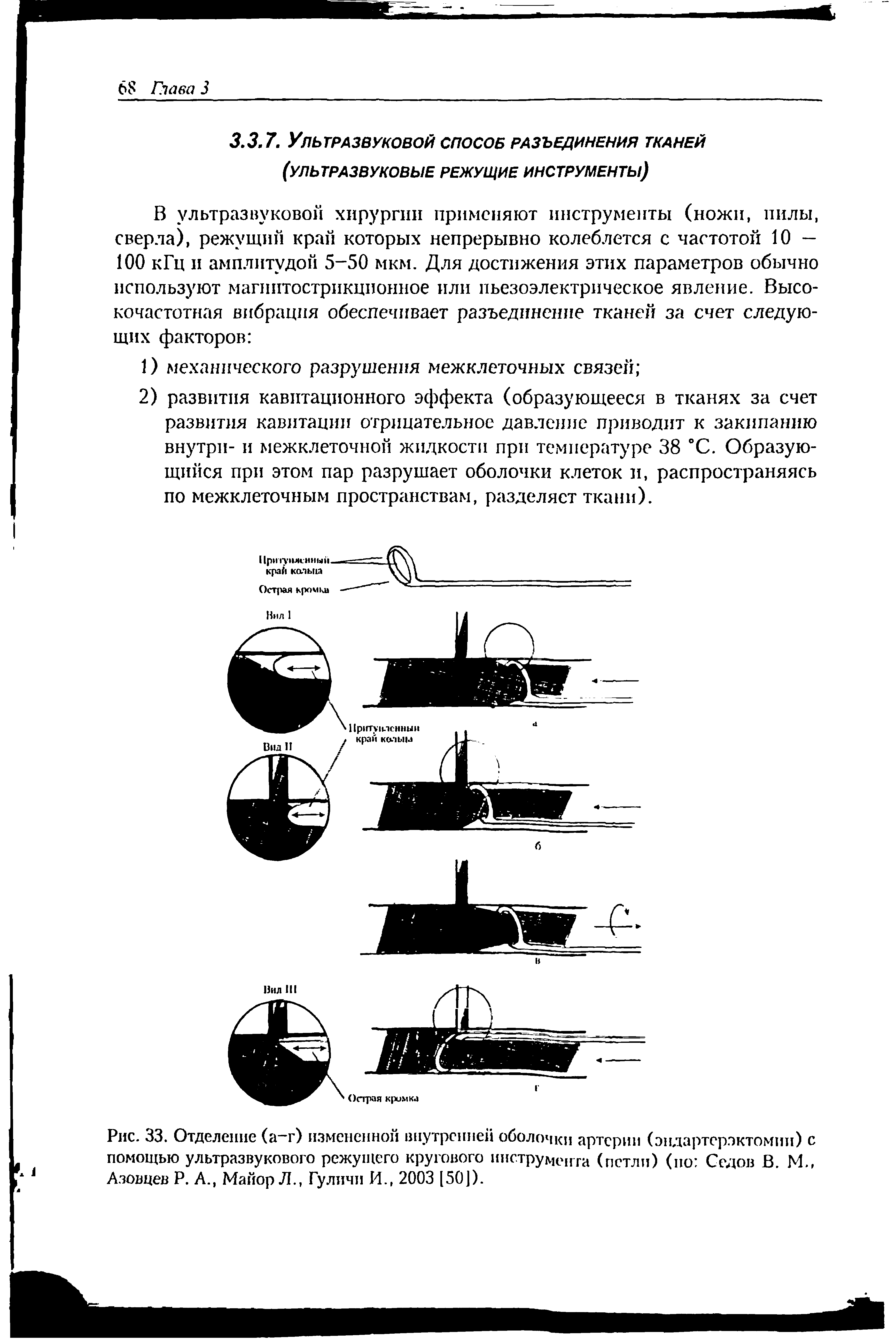 Рис. 33. Отделение (а-г) измененной внутренней оболочки артерии (эндартерэктомии) с помощью ультразвукового режущего кругового инструмента (петли) (но Седов В. И., Азовцев Р. А., Майор Л., Гуличи И., 2003 [50]).