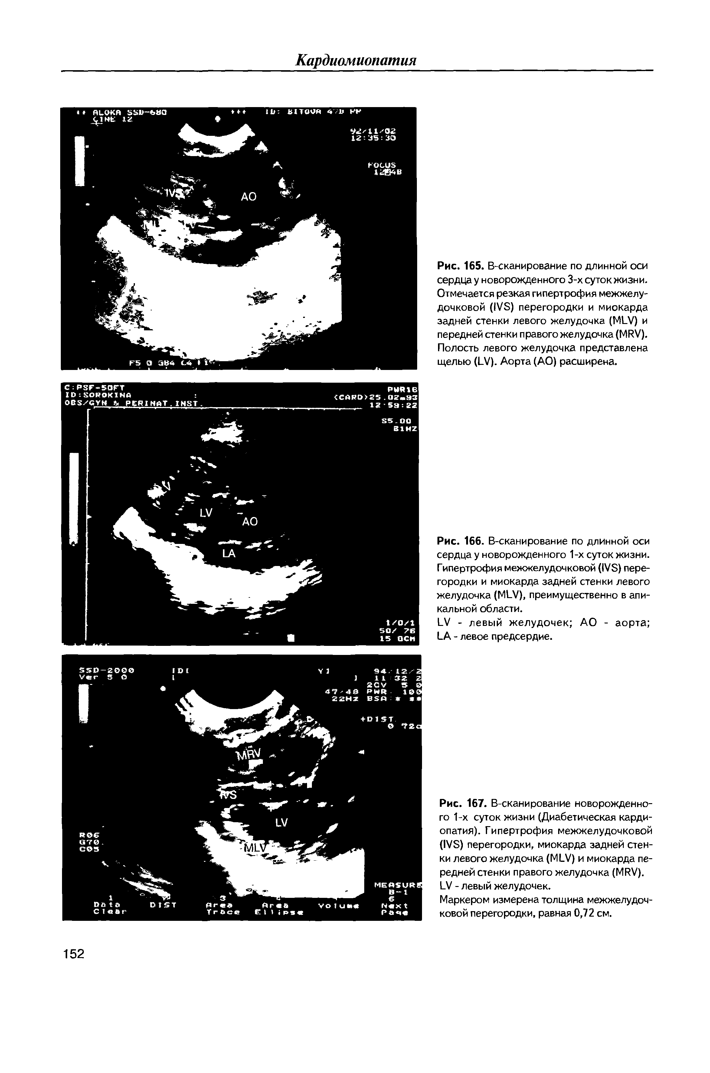 Рис. 167. В-сканирование новорожденного 1-х суток жизни (Диабетическая кардиопатия). Гипертрофия межжелудочковой (1УБ) перегородки, миокарда задней стенки левого желудочка (М1 У) и миокарда передней стенки правого желудочка (МРУ). ГУ - левый желудочек.