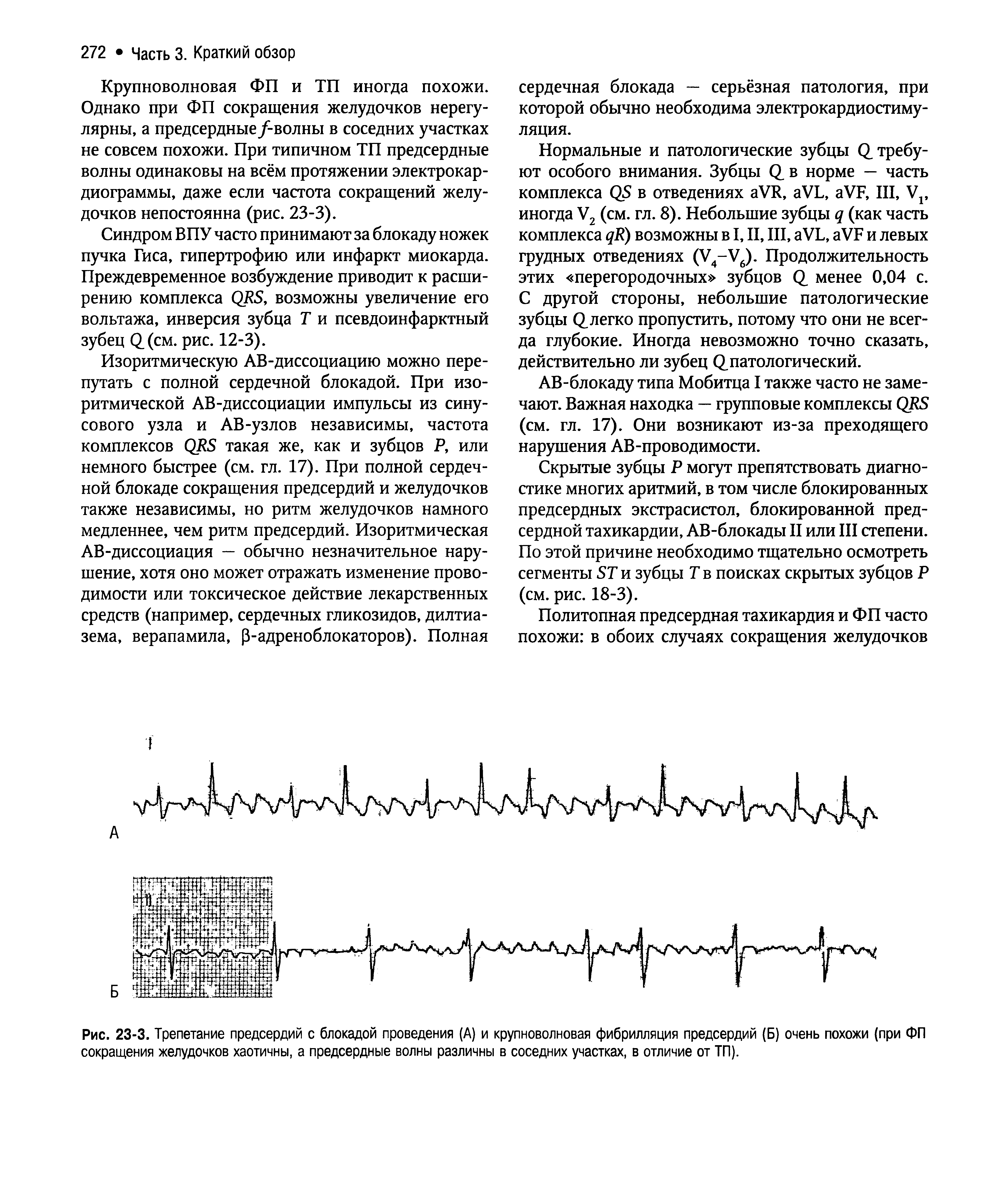 Рис. 23-3. Трепетание предсердий с блокадой проведения (А) и крупноволновая фибрилляция предсердий (Б) очень похожи (при ФП сокращения желудочков хаотичны, а предсердные волны различны в соседних участках, в отличие от ТП).