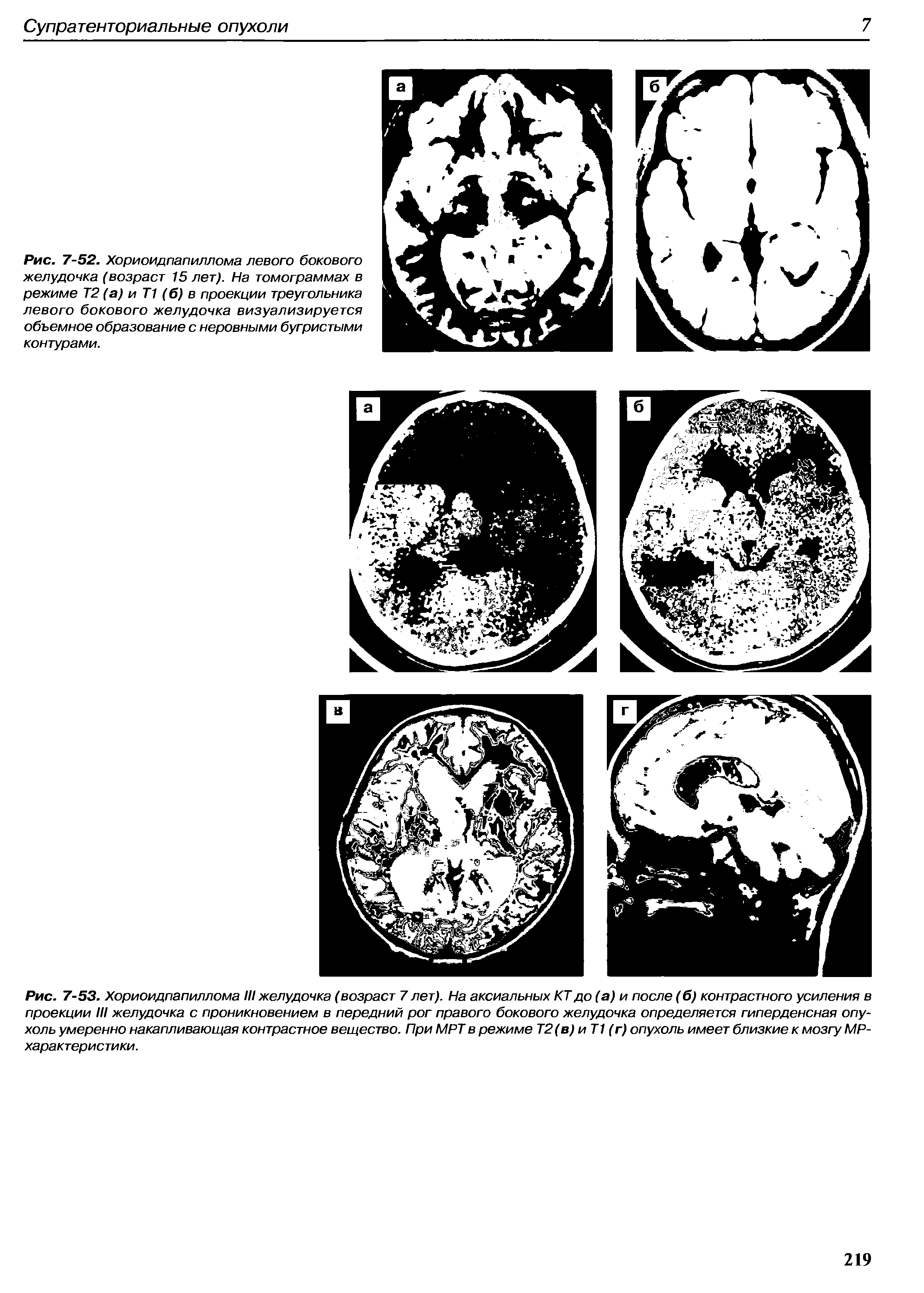 Рис. 7-53. Хориоидпапиллома III желудочка (возраст 7 лет). На аксиальных КТ до (а) и после (б) контрастного усиления в проекции III желудочка с проникновением в передний рог правого бокового желудочка определяется гиперденсная опухоль умеренно накапливающая контрастное вещество. При МРТ в режиме Т2(в) и Т1 (г) опухоль имеет близкие к мозгу МР-характеристики.