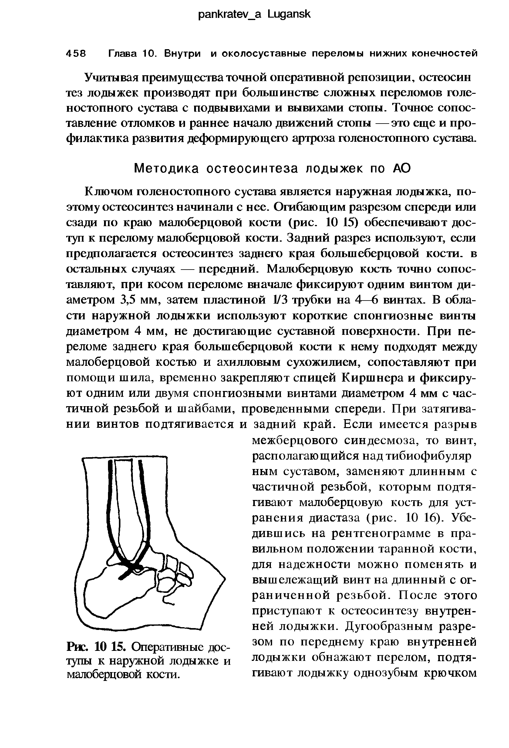 Рис. 10 15. Оперативные доступы к наружной лодыжке и малоберцовой кости.