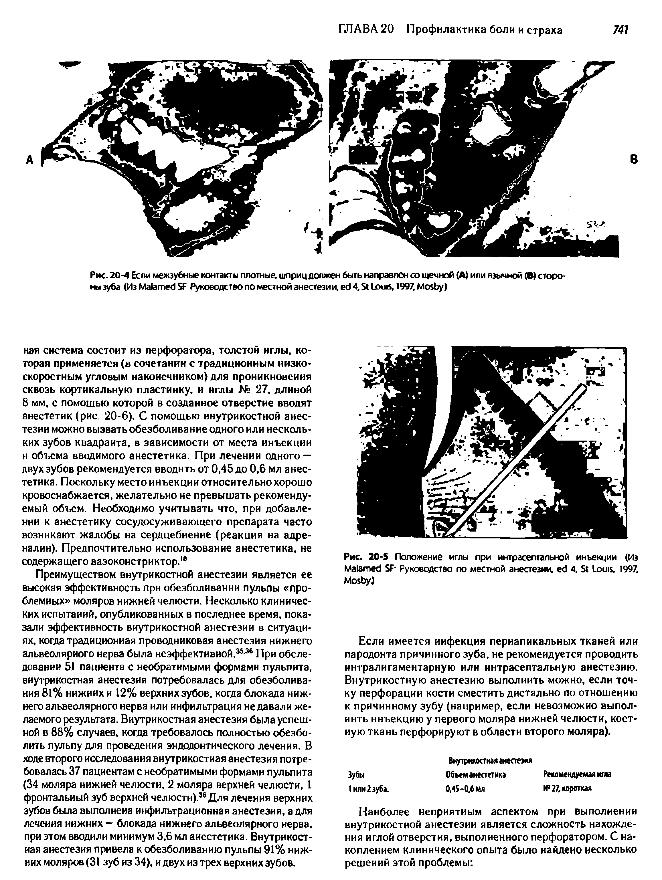 Рис. 20-S Положение иглы при интрасептальной инъекции (Из M SF Руководство по местной анестезии, 4, S L , 1997, M .)...