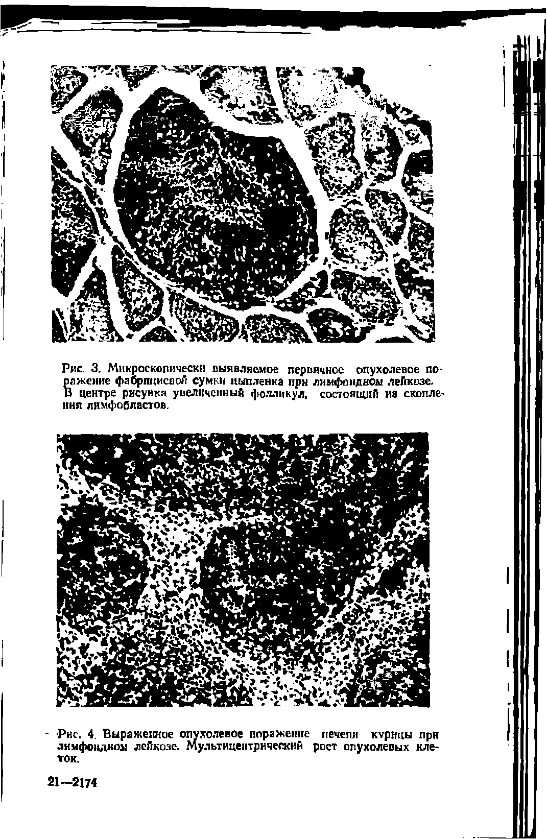 Рис. 4. Выраженное опухолевое поражение печени курицы прн лимфоидном лейкозе. Мультицеитрическнй рост опухолевых клеток.