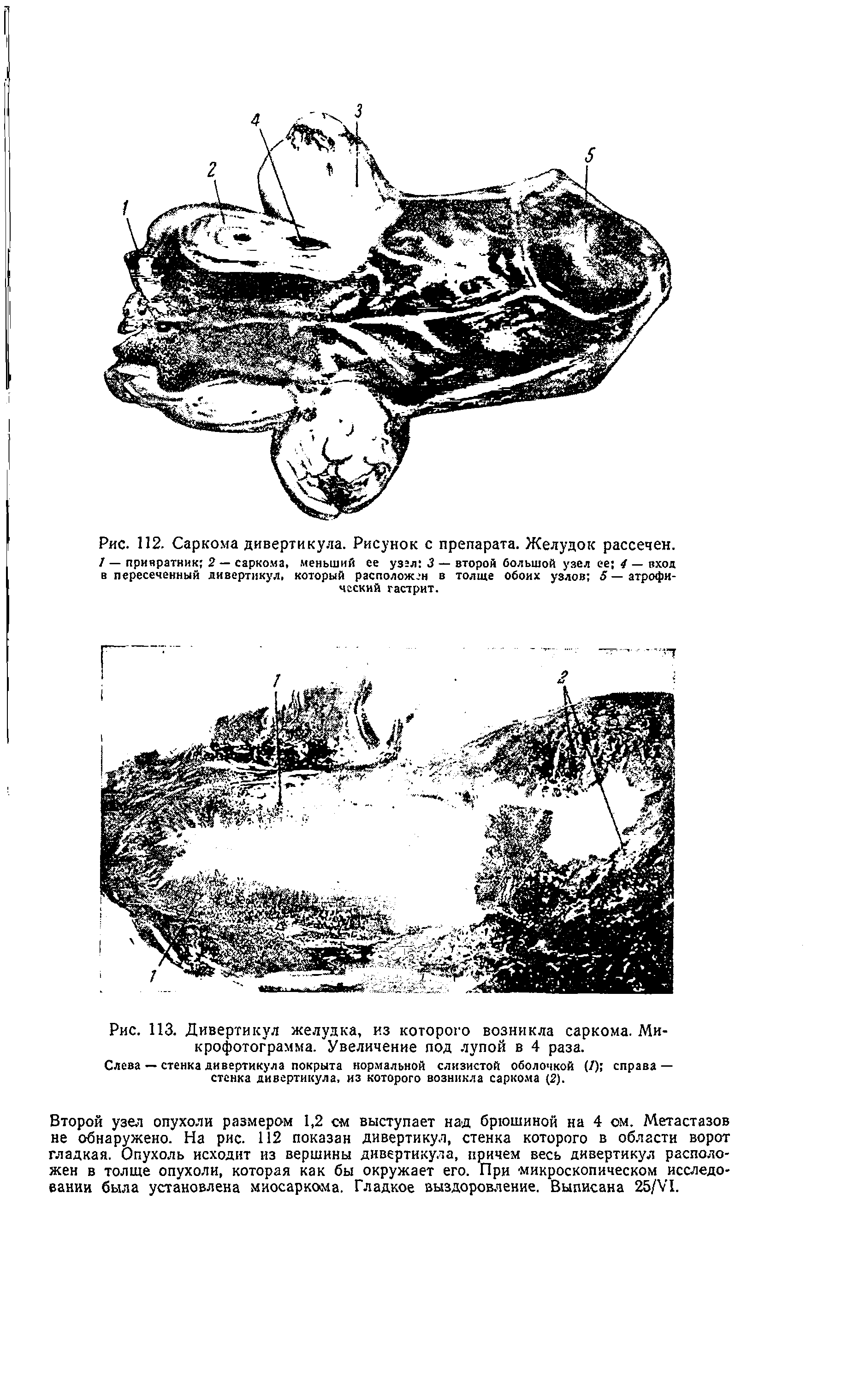 Рис. 113. Дивертикул желудка, из которого возникла саркома. Микрофотограмма. Увеличение под лупой в 4 раза.