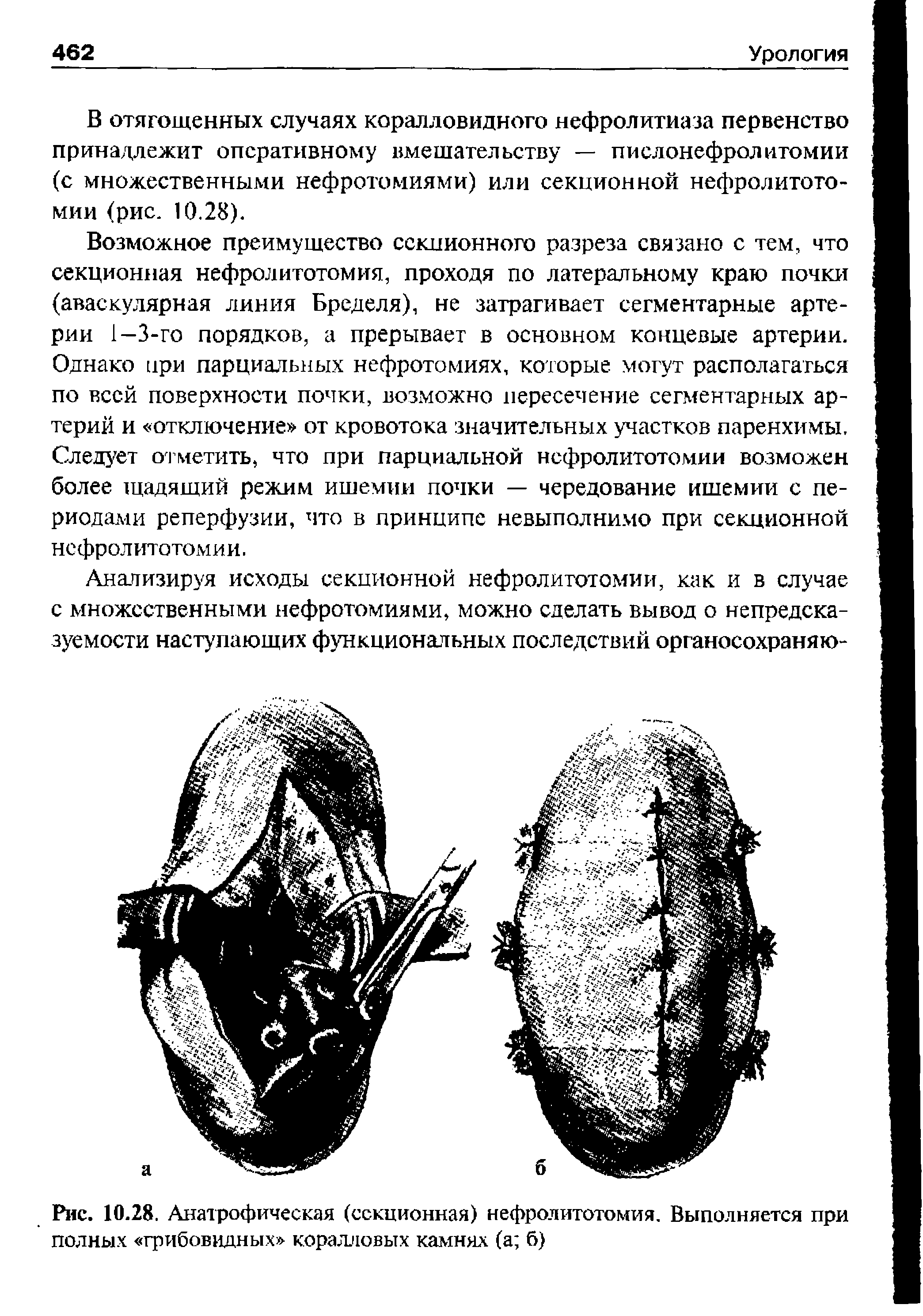 Рис. 10.28. Анатрофическая (секционная) нефролитотомия. Выполняется при полных грибовидных коралловых камнях (а б)...