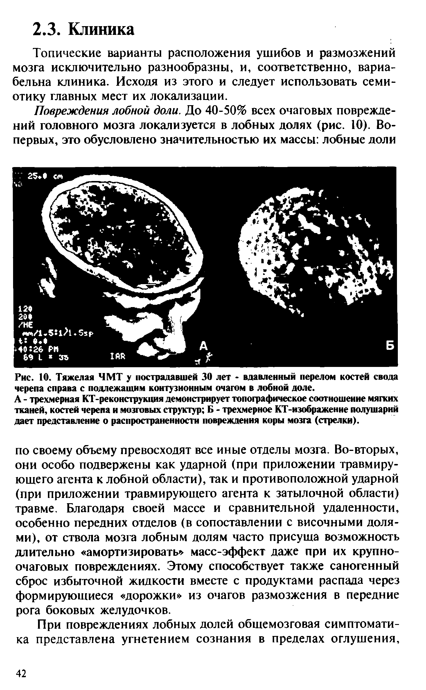 Рис. 10. Тяжелая ЧМТ у пострадавшей 30 лет - вдавленный перелом костей свода черепа справа с подлежащим контузионным очагом в лобной доле.