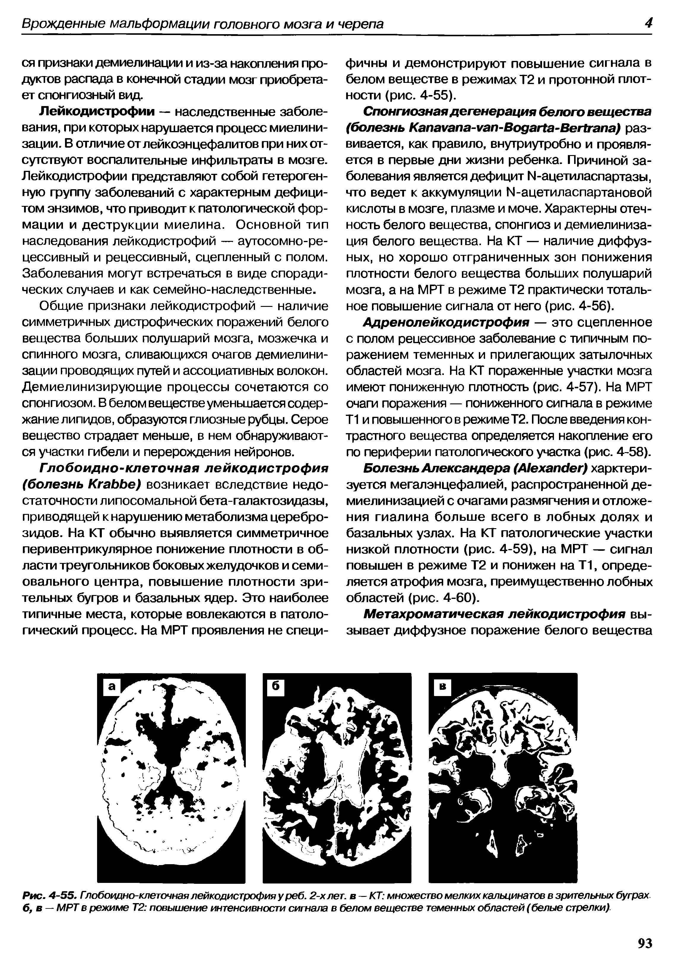 Рис. 4-55. Глобоидно-клеточная лейкодистрофия у реб. 2-хлет. в — КТ множество мелких кальцинатов в зрительных буграх б, в — МРТ в режиме Т2 повышение интенсивности сигнала в белом веществе теменных областей (белые стрелки).