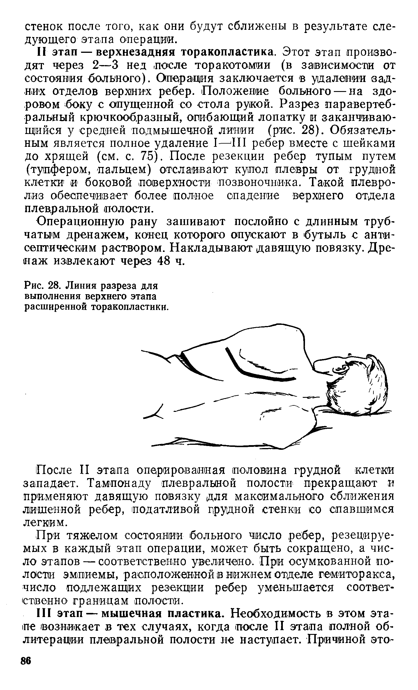 Рис. 28. Линия разреза для выполнения верхнего этапа расширенной торакопластики.