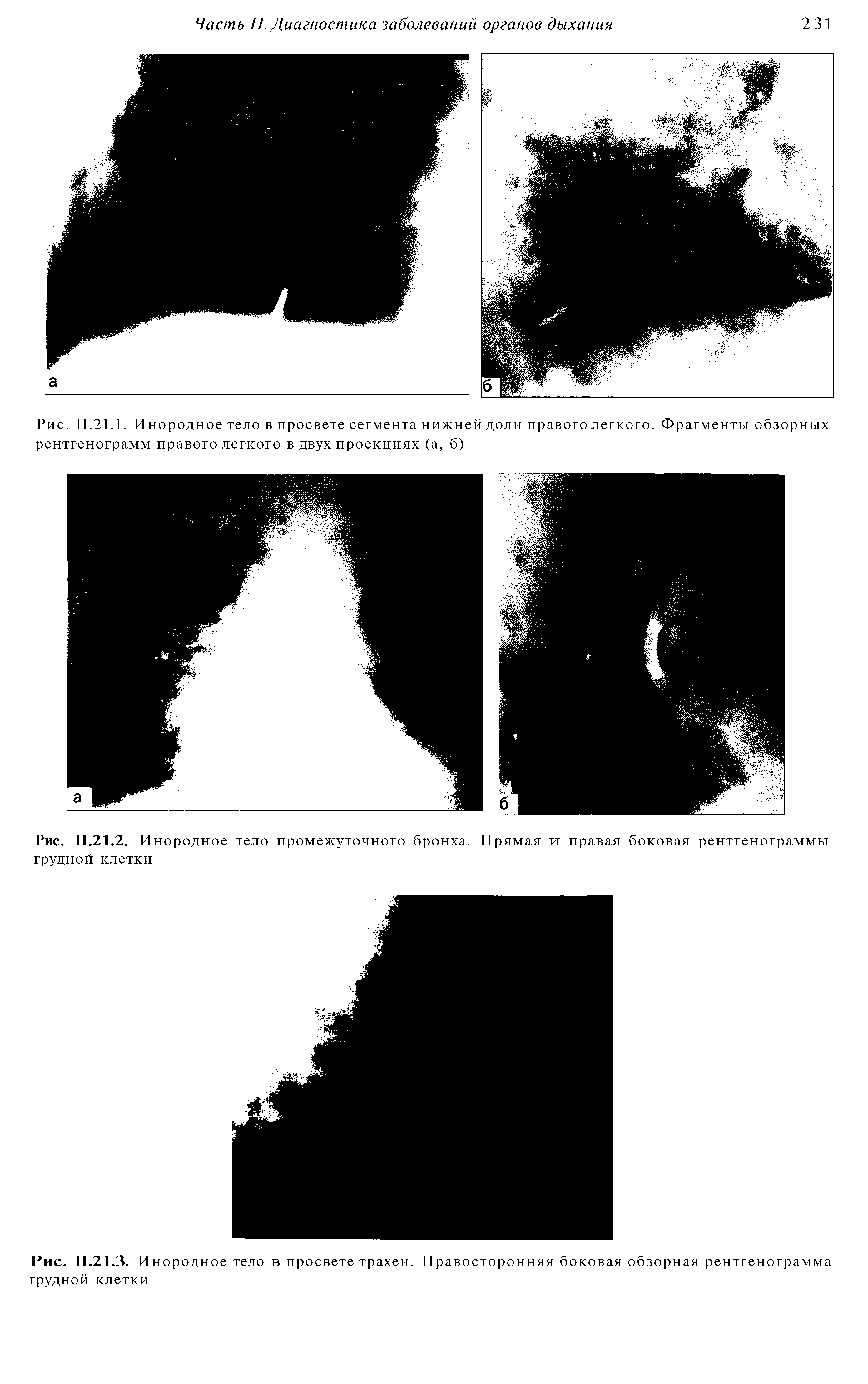 Рис. 11.21.1. Инородное тело в просвете сегмента нижней доли правого легкого. Фрагменты обзорных рентгенограмм правого легкого в двух проекциях (а, б)...