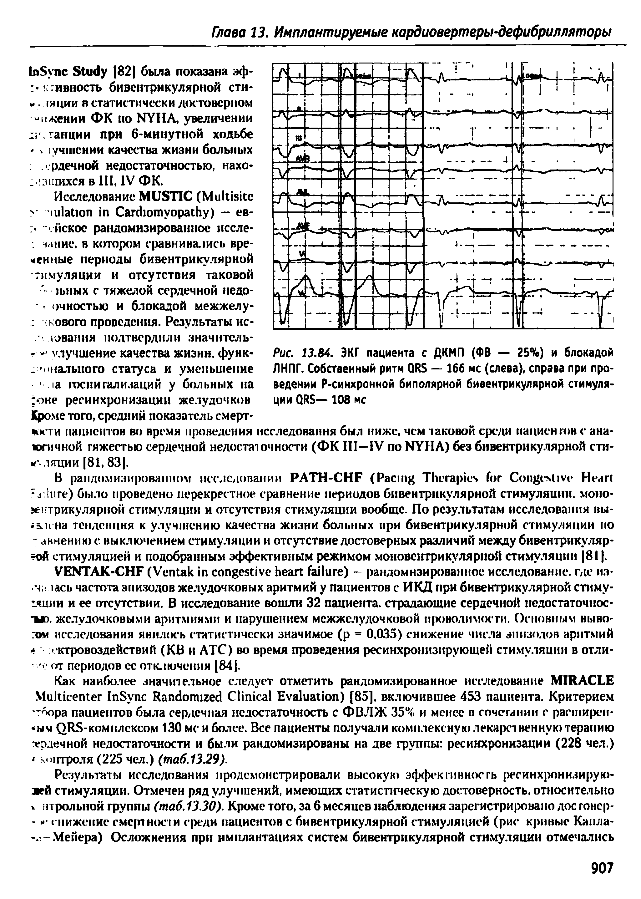 Рис. 13.84. ЭКГ пациента с ДКМП (ФВ — 25%) и блокадой ЛНПГ. Собственный ритм QRS — 166 мс (слева), справа при проведении Р-синхронной биполярной бивентрикулярной стимуляции QRS— 108 мс...