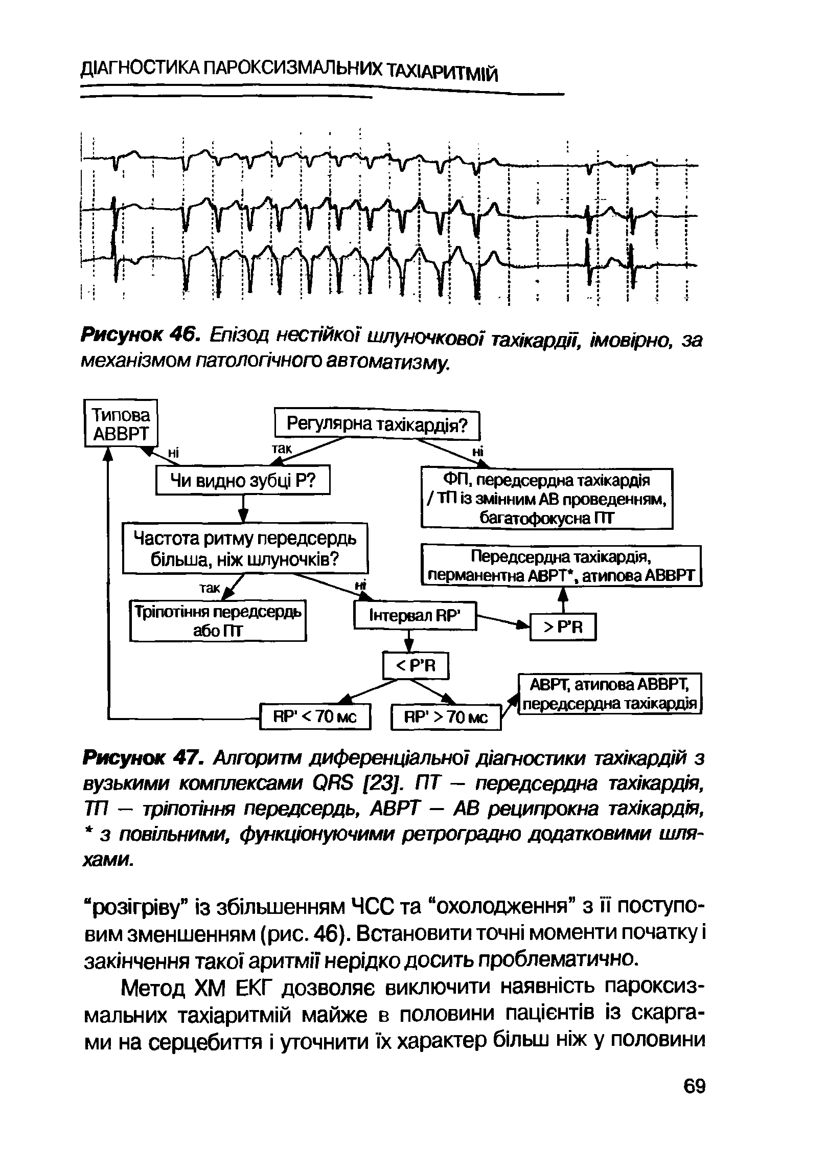 Рисунок 47. Алгоритм диференц1ально1 д/агностики тах/кард1й з вузькими комплексами ОИБ [23]. ПТ — передсердна тах/кард/я, ТП — тр/попння передсердь, АВРТ — АВ реципрокна тах кард 1я, з повшьними, функцюнуючими ретроградно додатковими шляхами.