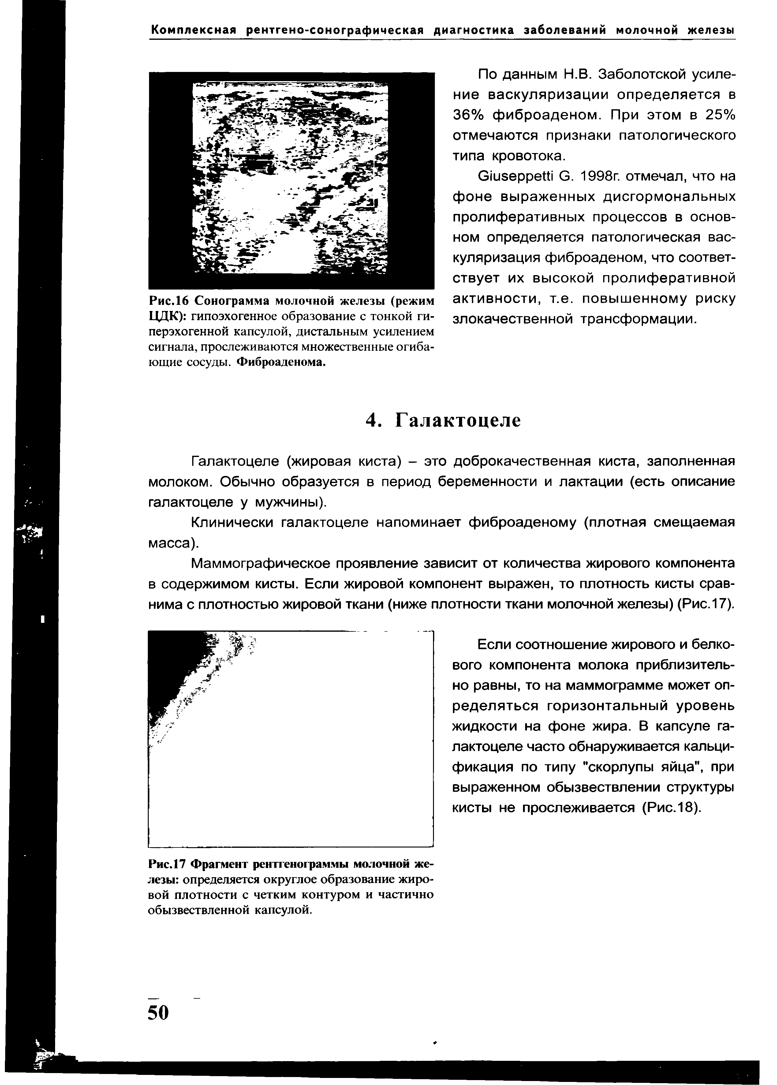 Рис.16 Сонограмма молочной железы (режим ЦДК) гипоэхогенное образование с тонкой гиперэхогенной капсулой, дистальным усилением сигнала, прослеживаются множественные огибающие сосуды. Фиброаденома.