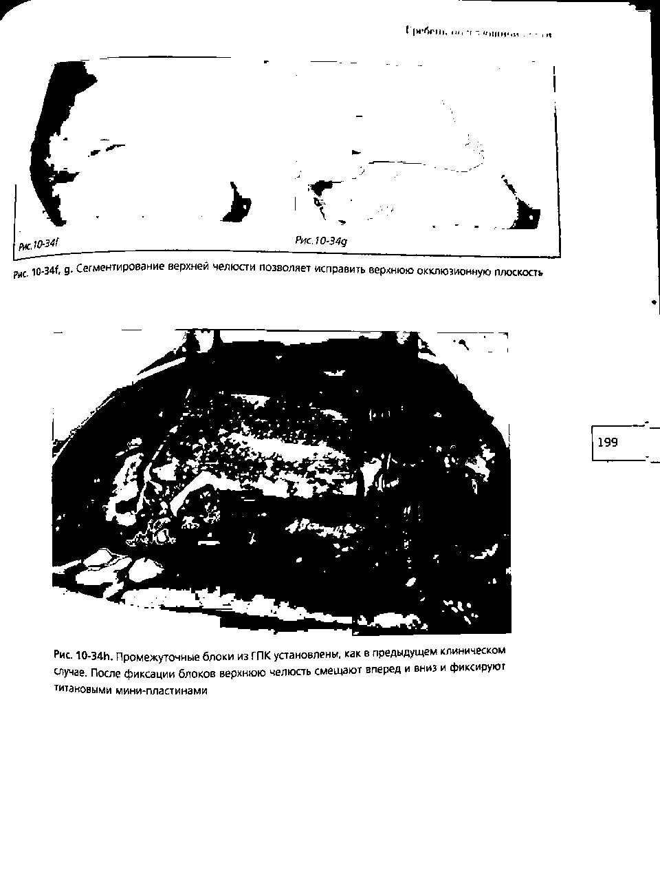 Рис. 10-34И. Промежуточные блоки из ГПК установлены, как в предыдущем клиническом случае. После фиксации блоков верхнюю челюсть смещают вперед и вниз и фиксируют титановыми мини-пластинами...