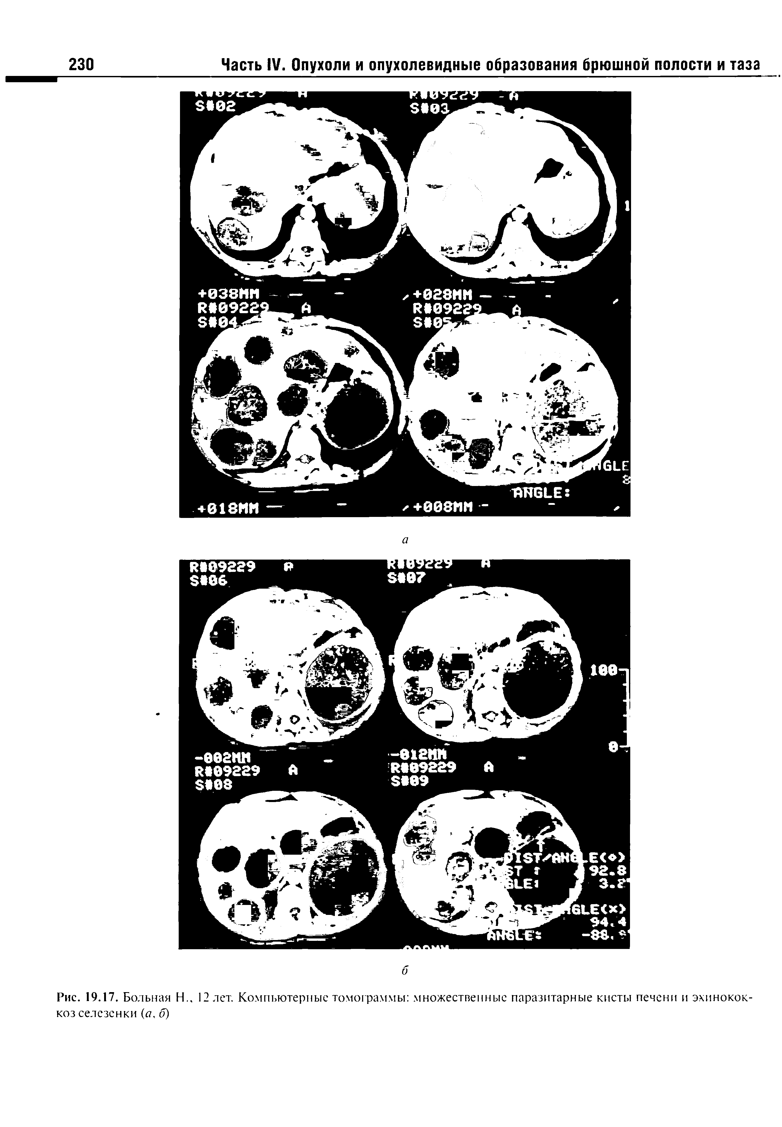 Рис. 19.17. Больная Н.. 12 лет. Компьютерные томограммы множественные паразитарные кисты печени и эхинококкоз селезенки ( 7, о)...