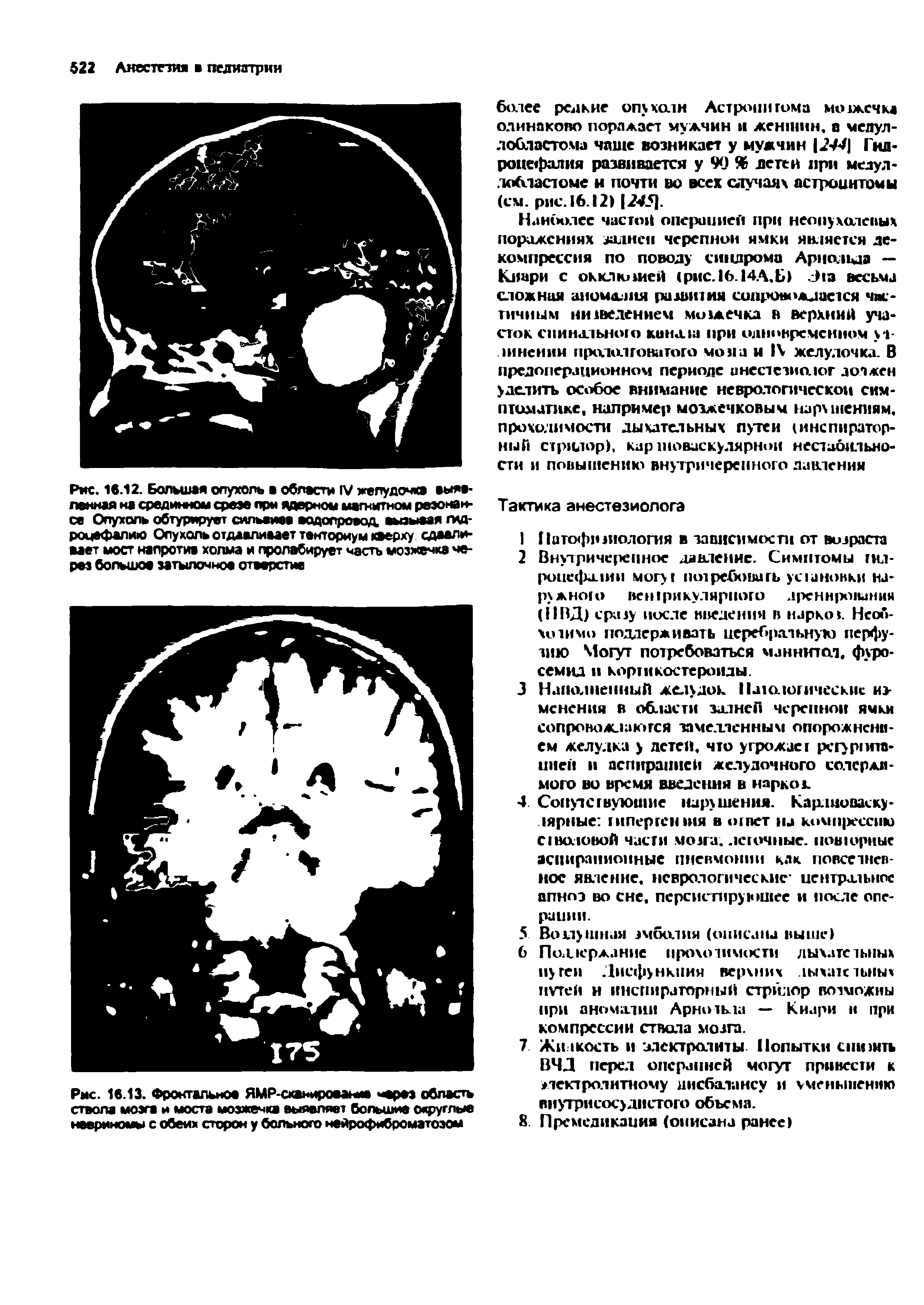 Рис. 16.13. Фронтальное ЯМР-сканирооамю через область ствола мозга и моста мозжечка выявляет большие округлые невриномы с обеих сторон у больного неврофиброматозом...