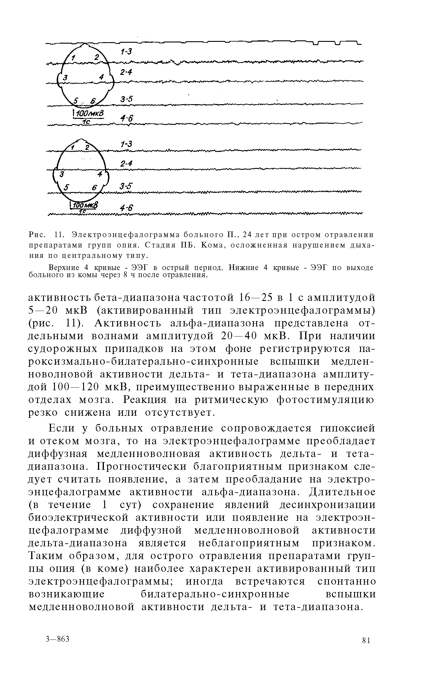 Рис. И. Электроэнцефалограмма больного П., 24 лет при остром отравлении препаратами групп опия. Стадия ПБ. Кома, осложненная нарушением дыхания по центральному типу.