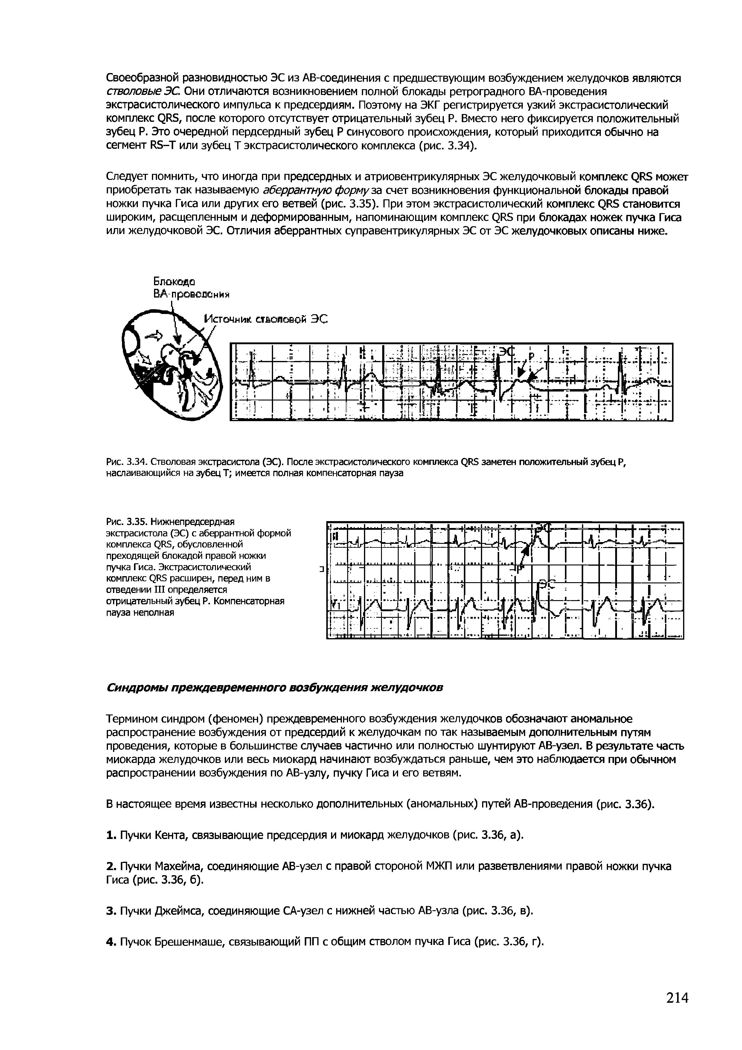 Рис. 3.35. Нижнепредсердная экстрасистола (ЭС) с аберрантной формой комплекса (2И5, обусловленной преходящей блокадой правой ножки пучка Гиса. Экстрасистолический комплекс (2135 расширен, перед ним в отведении III определяется отрицательный зубец Р. Компенсаторная пауза неполная...