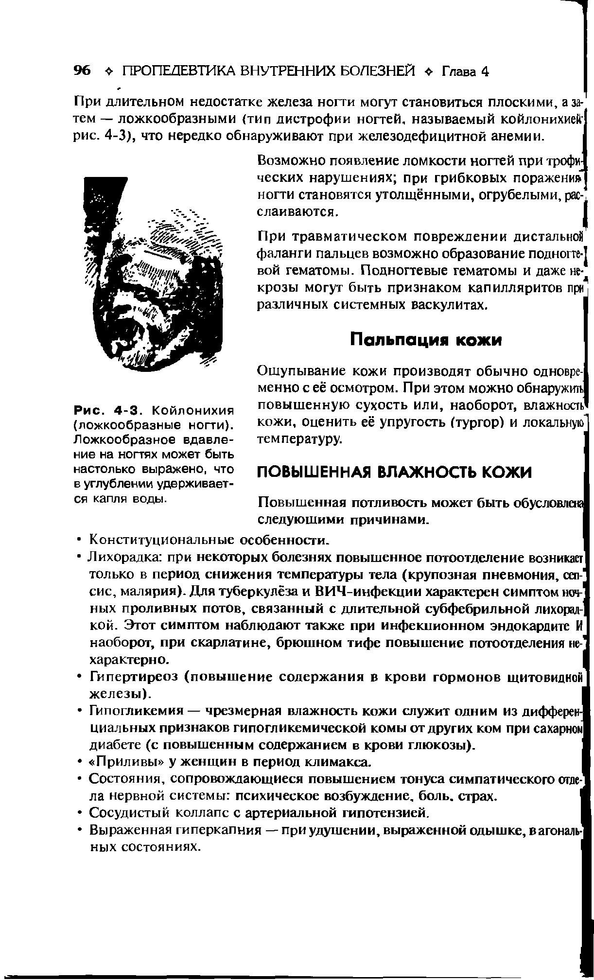 Рис. 4-3. Койлонихия (ложкообразные ногти). Ложкообразное вдавле-ние на ногтях может быть настолько выражено, что в углублении удерживается капля воды.