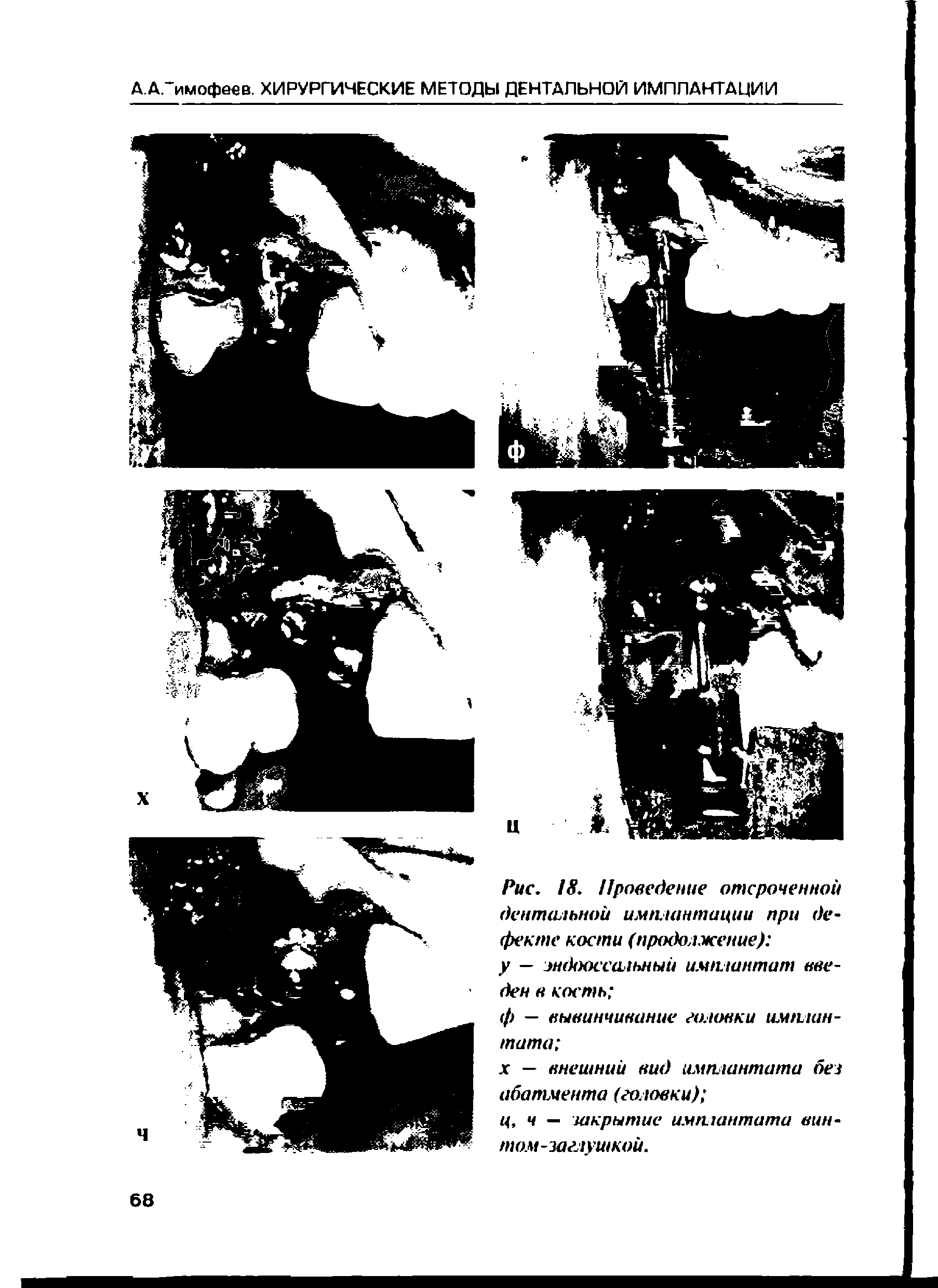 Рис. 18. Проведение отсроченной дентальной имплантации при дефекте кости (продолжение) у — эндооссальный имплантат введен в кость ...