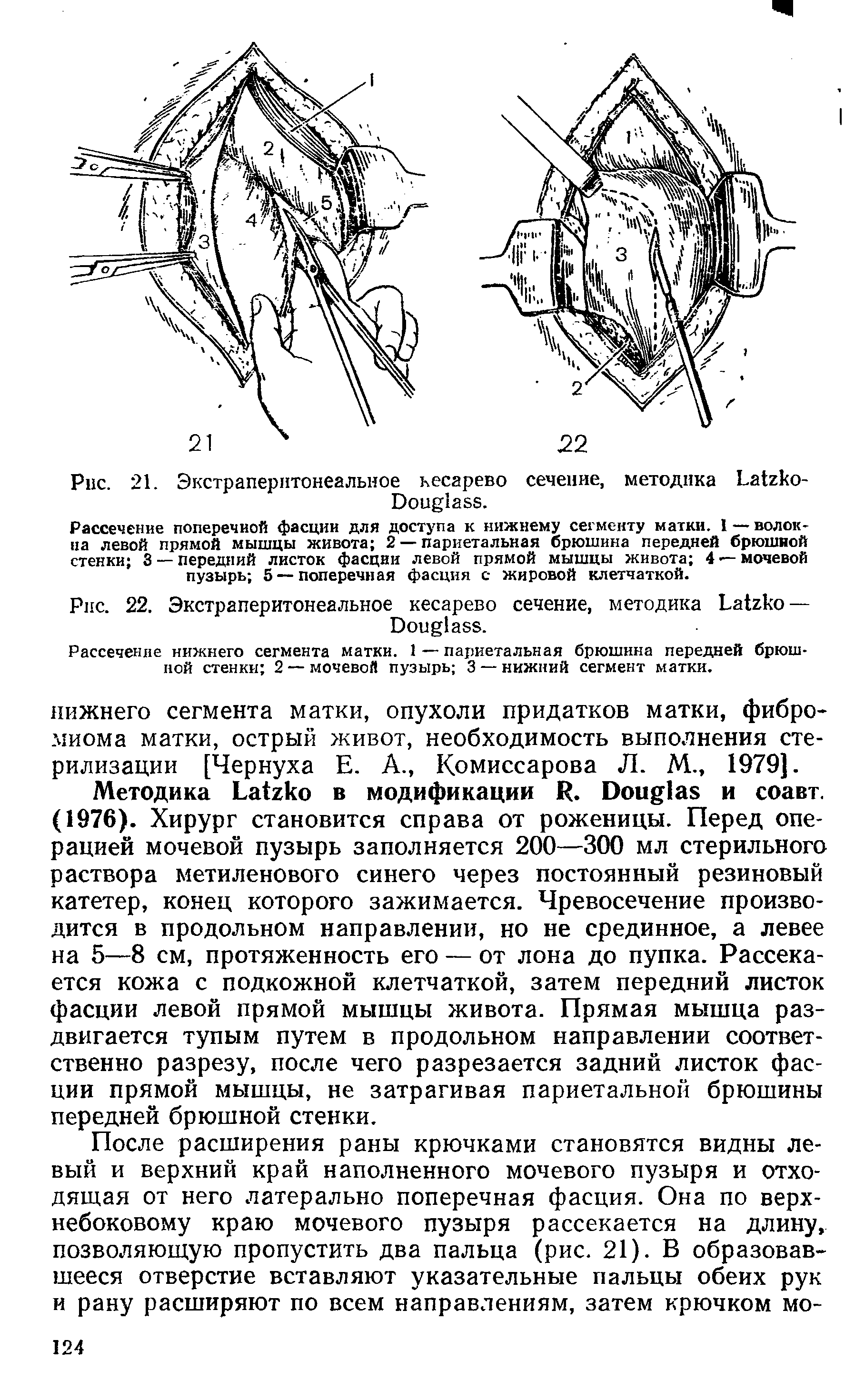 Рис. 21. Экстраперитонеальное кесарево сечение, методика L -D .