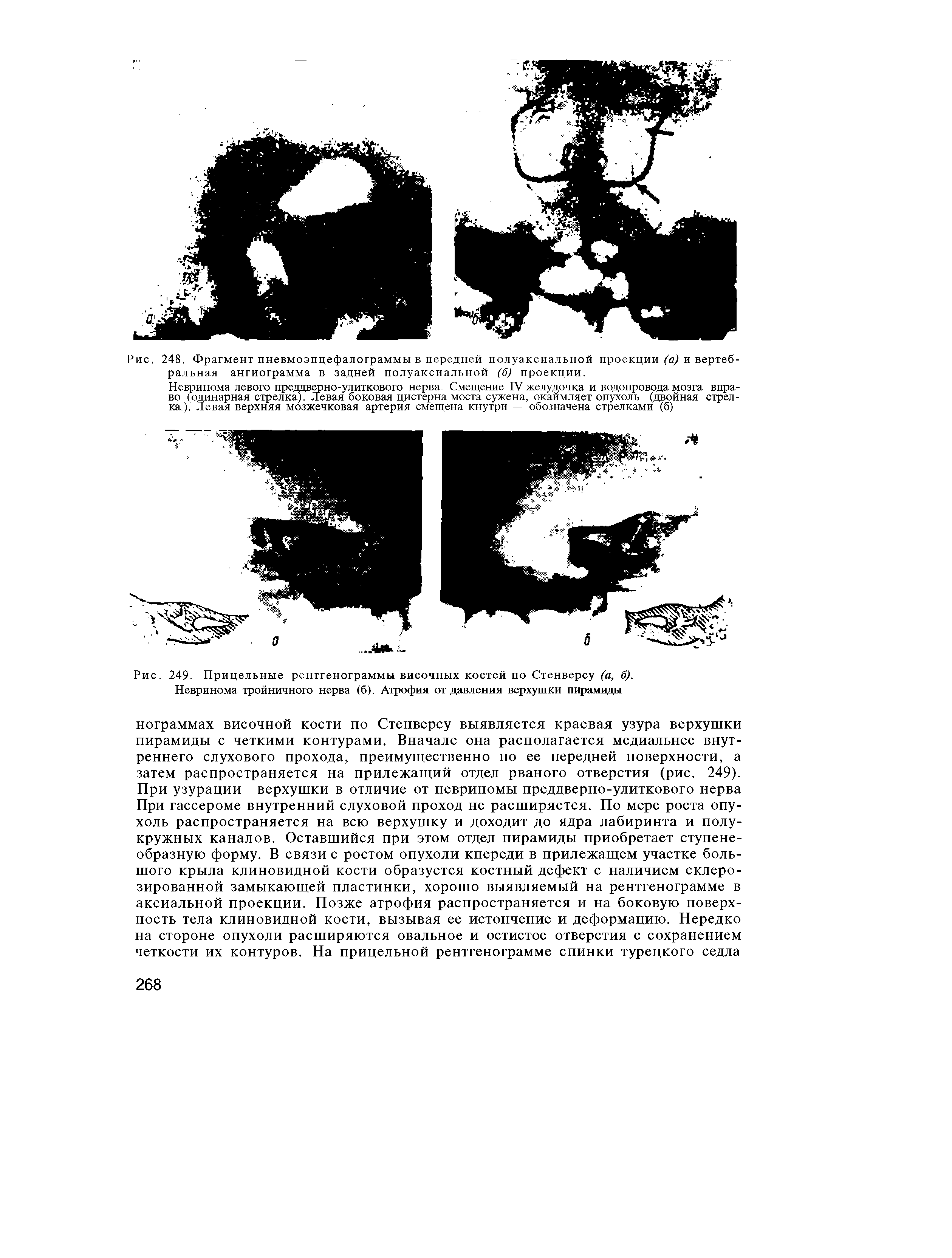 Рис. 249. Прицельные рентгенограммы височных костей по Стенверсу (а, б). Невринома тройничного нерва (б). Атрофия от давления верхушки пирамиды...