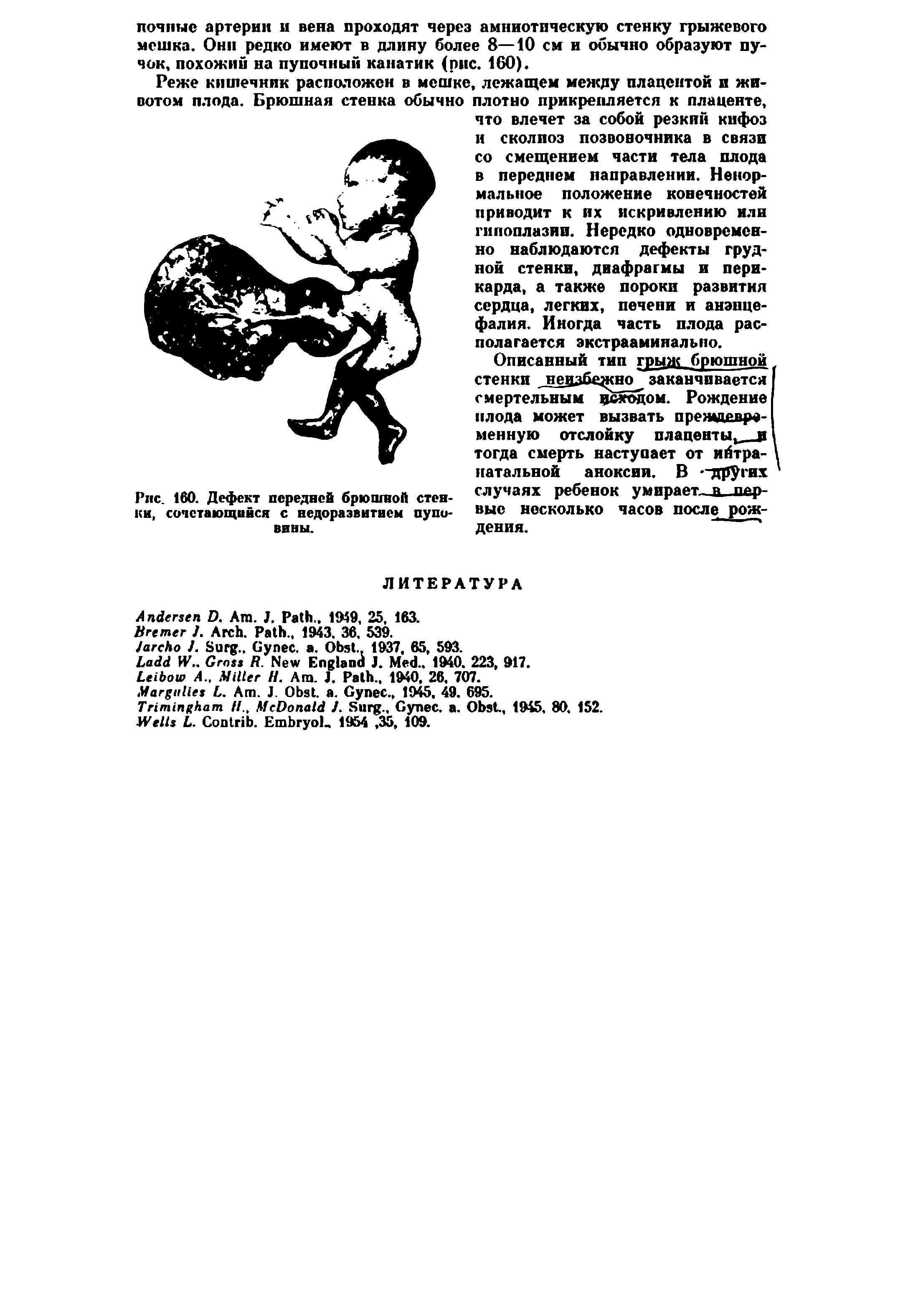 Рис. 160. Дефект передней брюшной стенки, сочетающийся с недоразвитием пуповины.