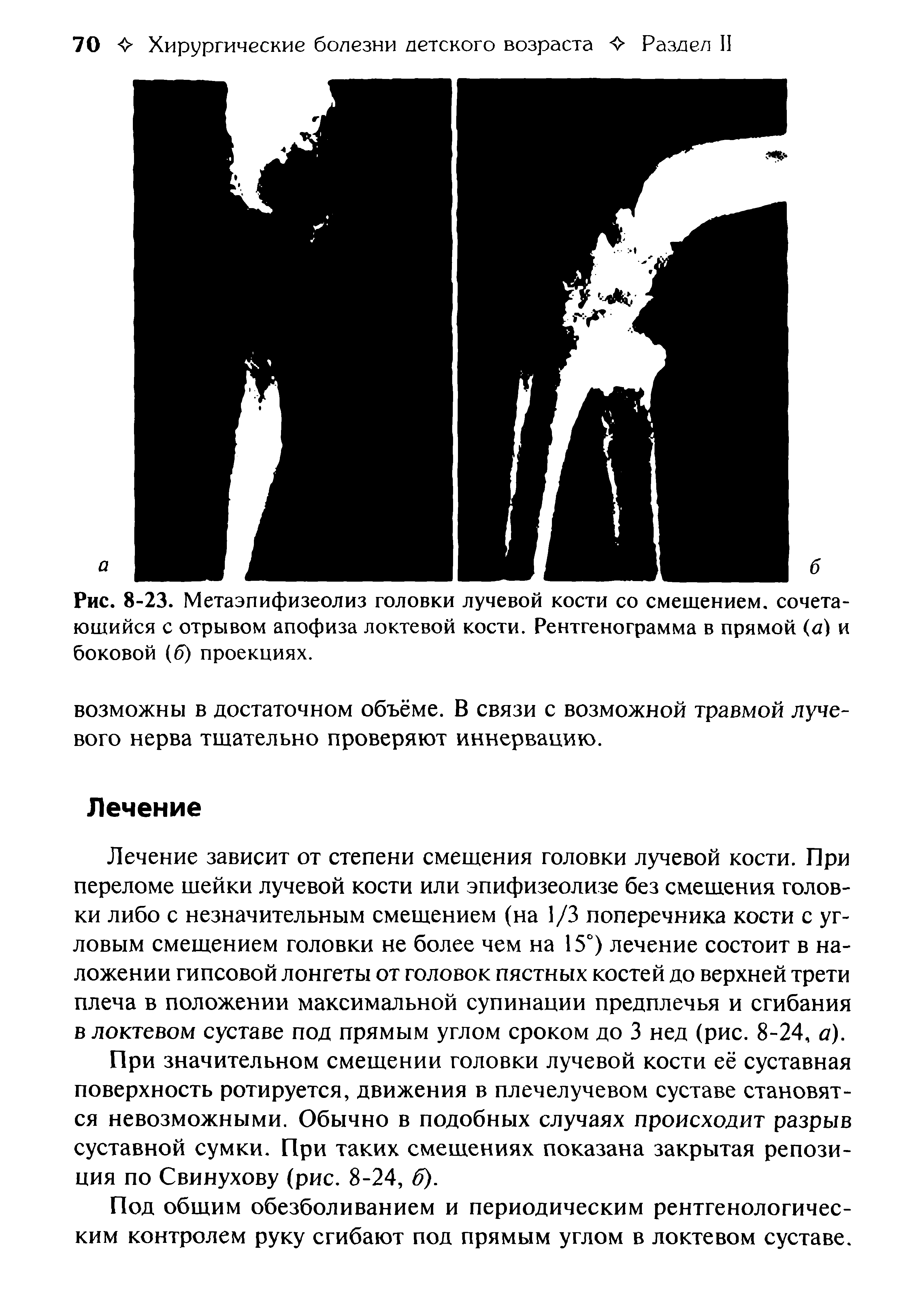 Рис. 8-23. Метаэпифизеолиз головки лучевой кости со смешением, сочетающийся с отрывом апофиза локтевой кости. Рентгенограмма в прямой (д) и боковой (б) проекциях.