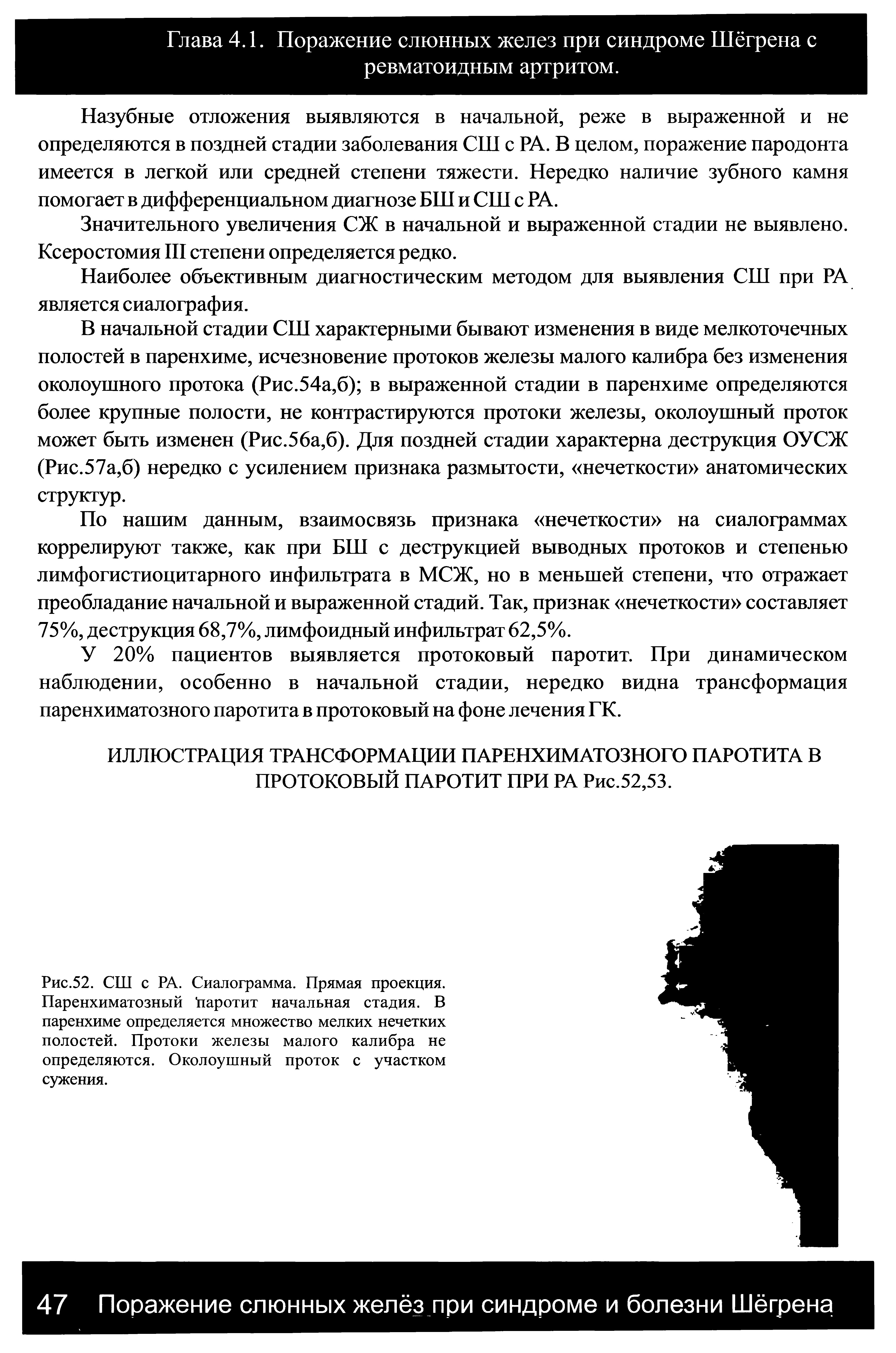 Рис.52. СШ с РА. Сиалограмма. Прямая проекция. Паренхиматозный паротит начальная стадия. В паренхиме определяется множество мелких нечетких полостей. Протоки железы малого калибра не определяются. Околоушный проток с участком сужения.