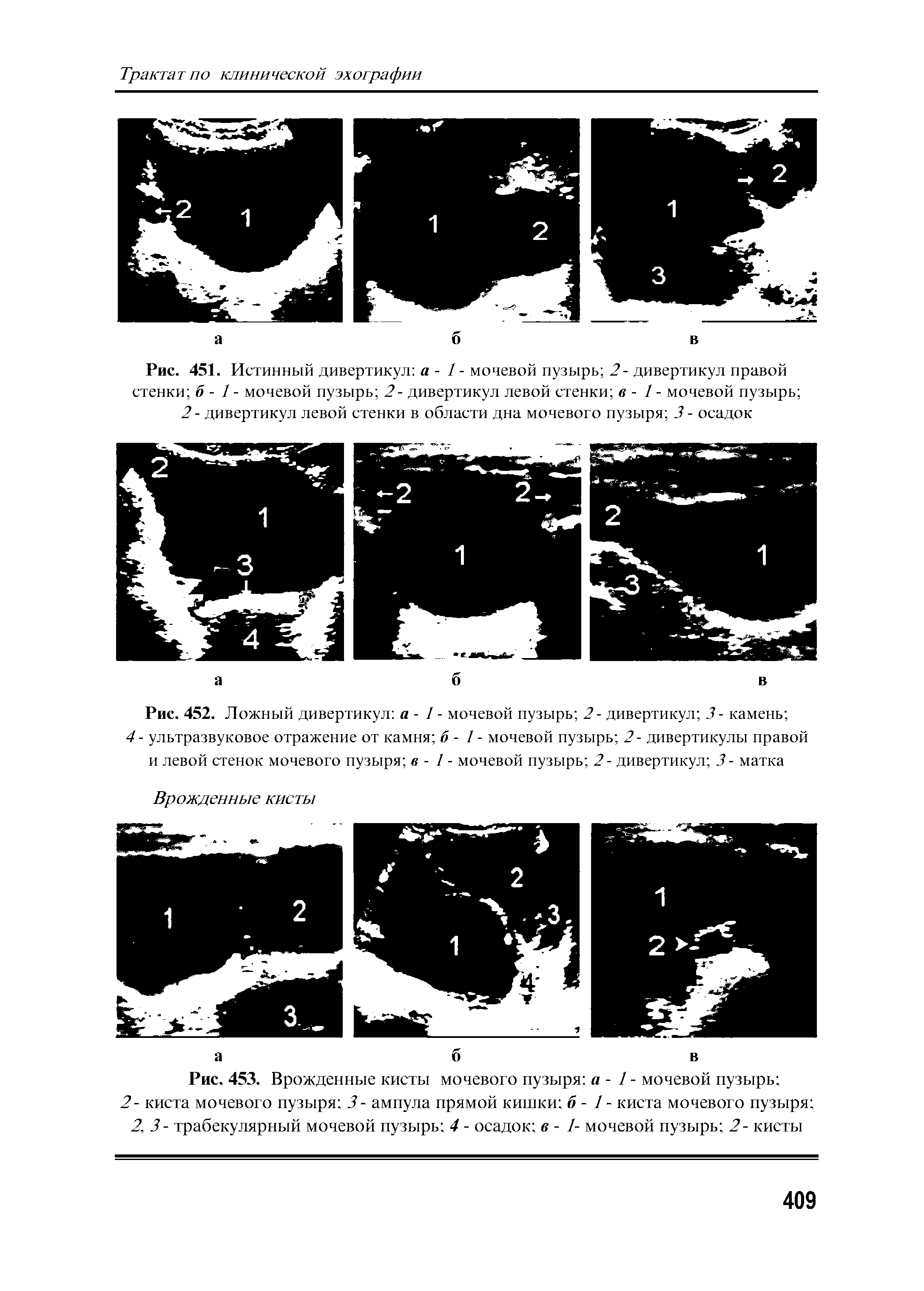 Рис. 452. Ложный дивертикул а - 1 - мочевой пузырь 2 - дивертикул 3 - камень ...