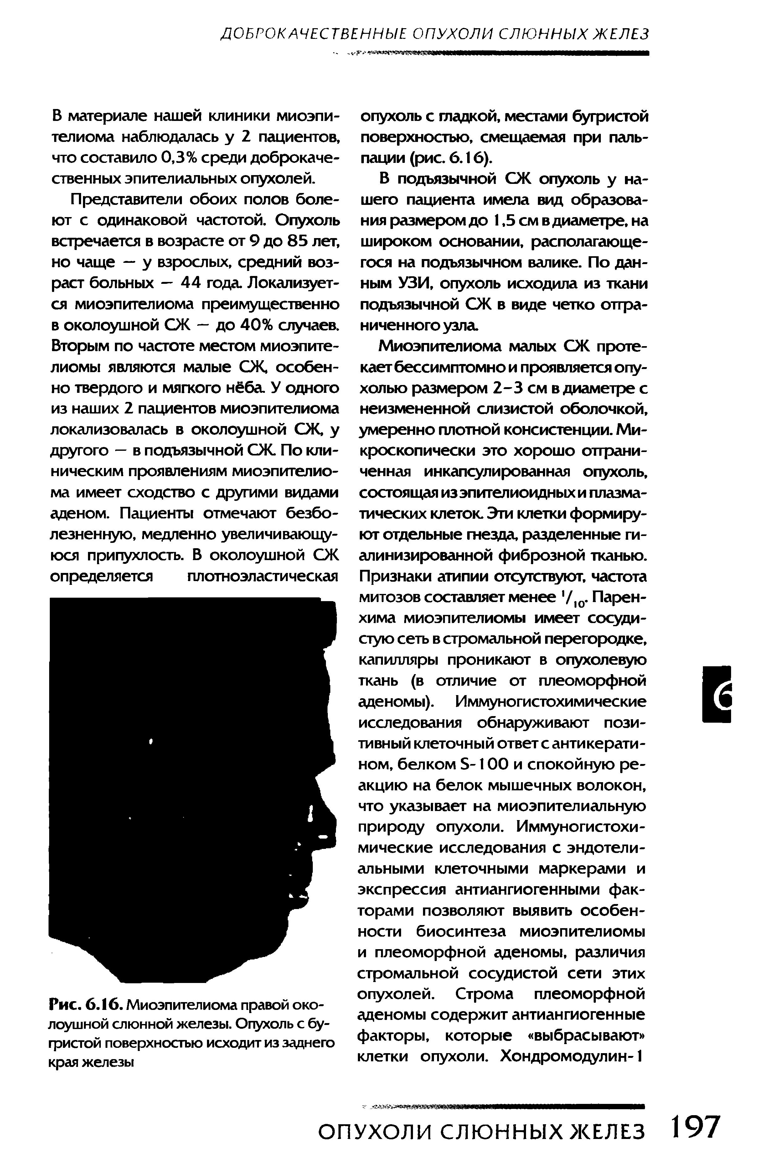 Рис. 6.16. Миоэпителиома правой околоушной слюнной железы. Опухоль с бугристой поверхностью исходит из заднего края железы...